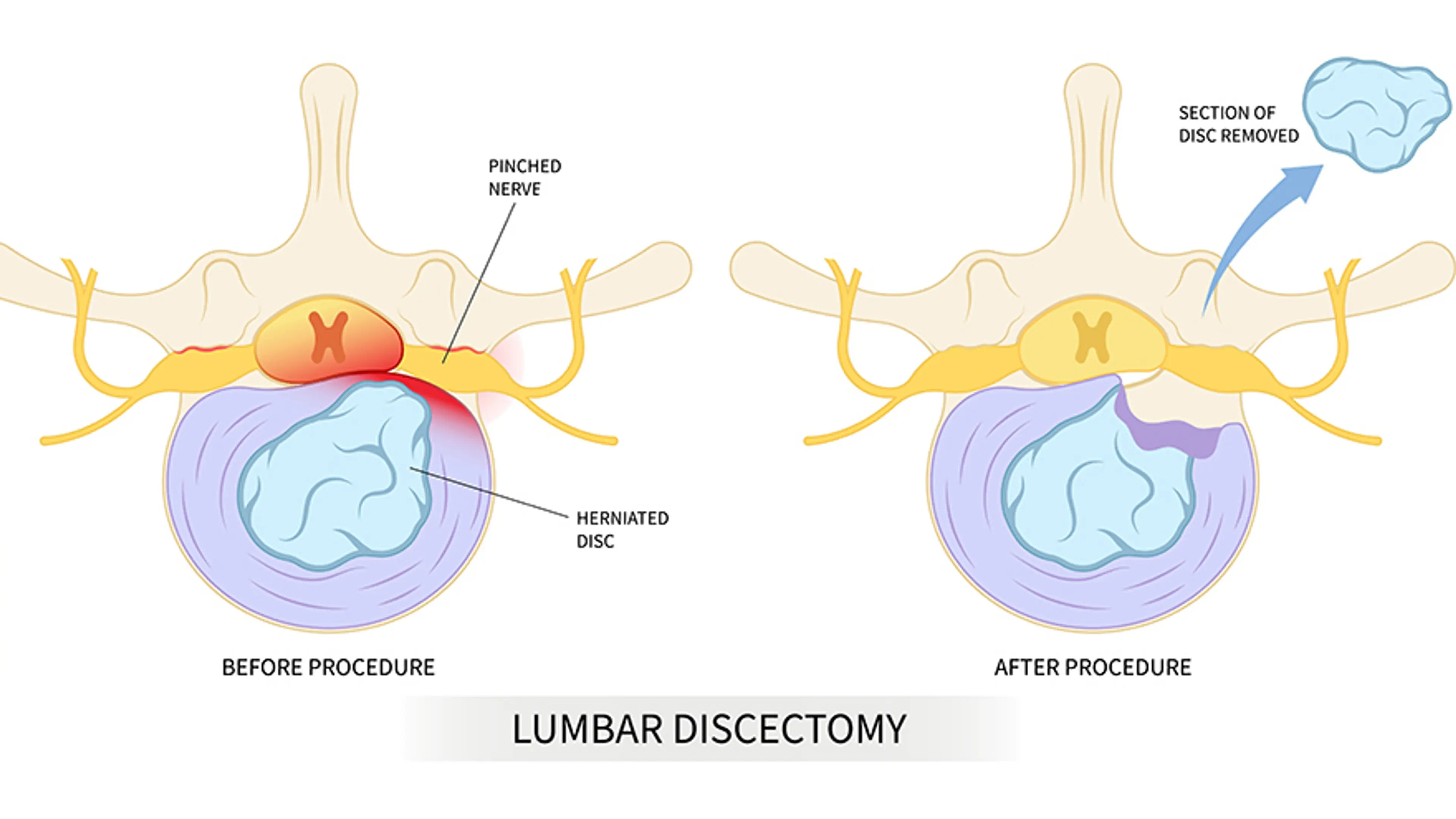 Herniated Discs