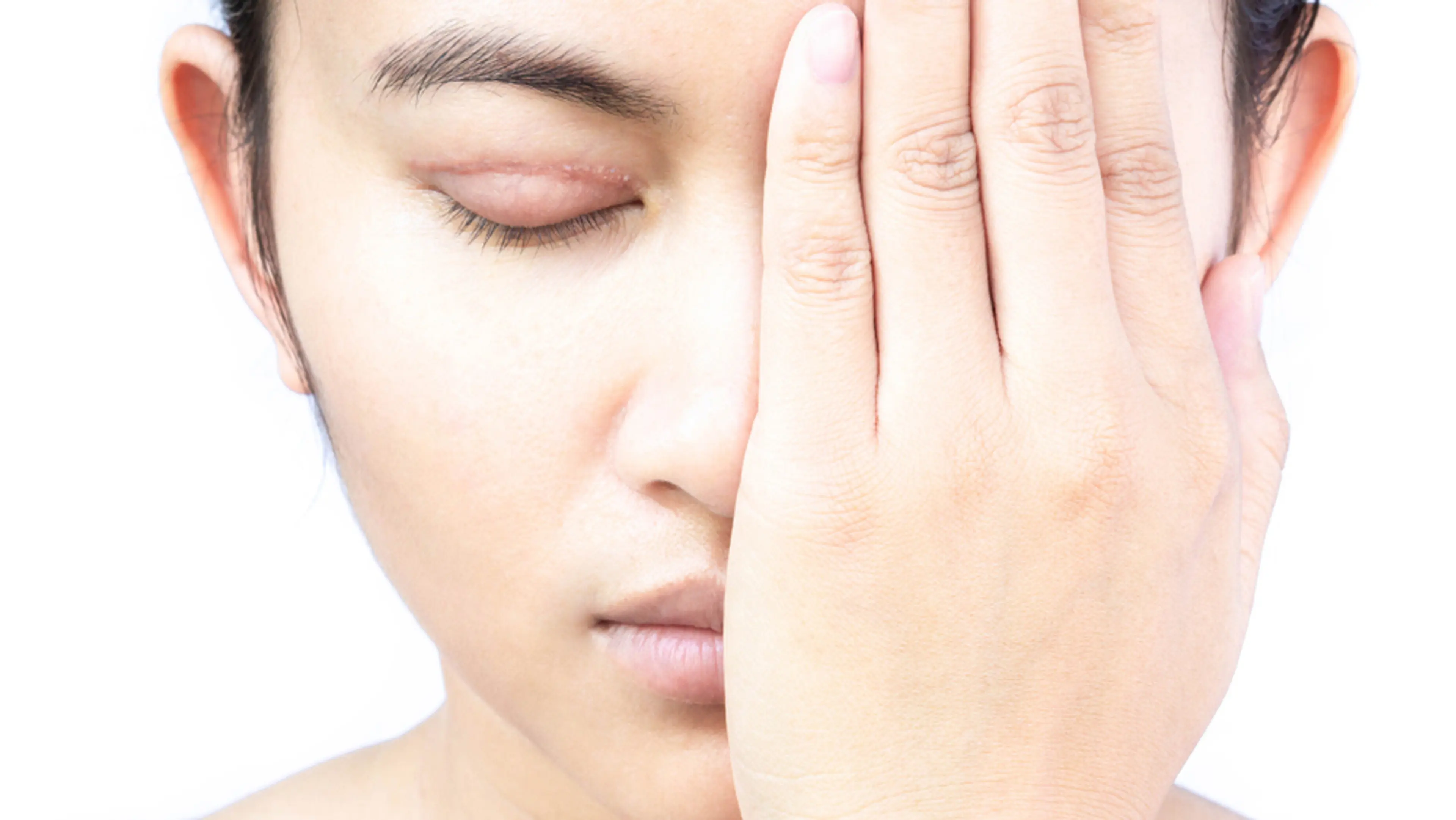 Double Eyelid Surgery