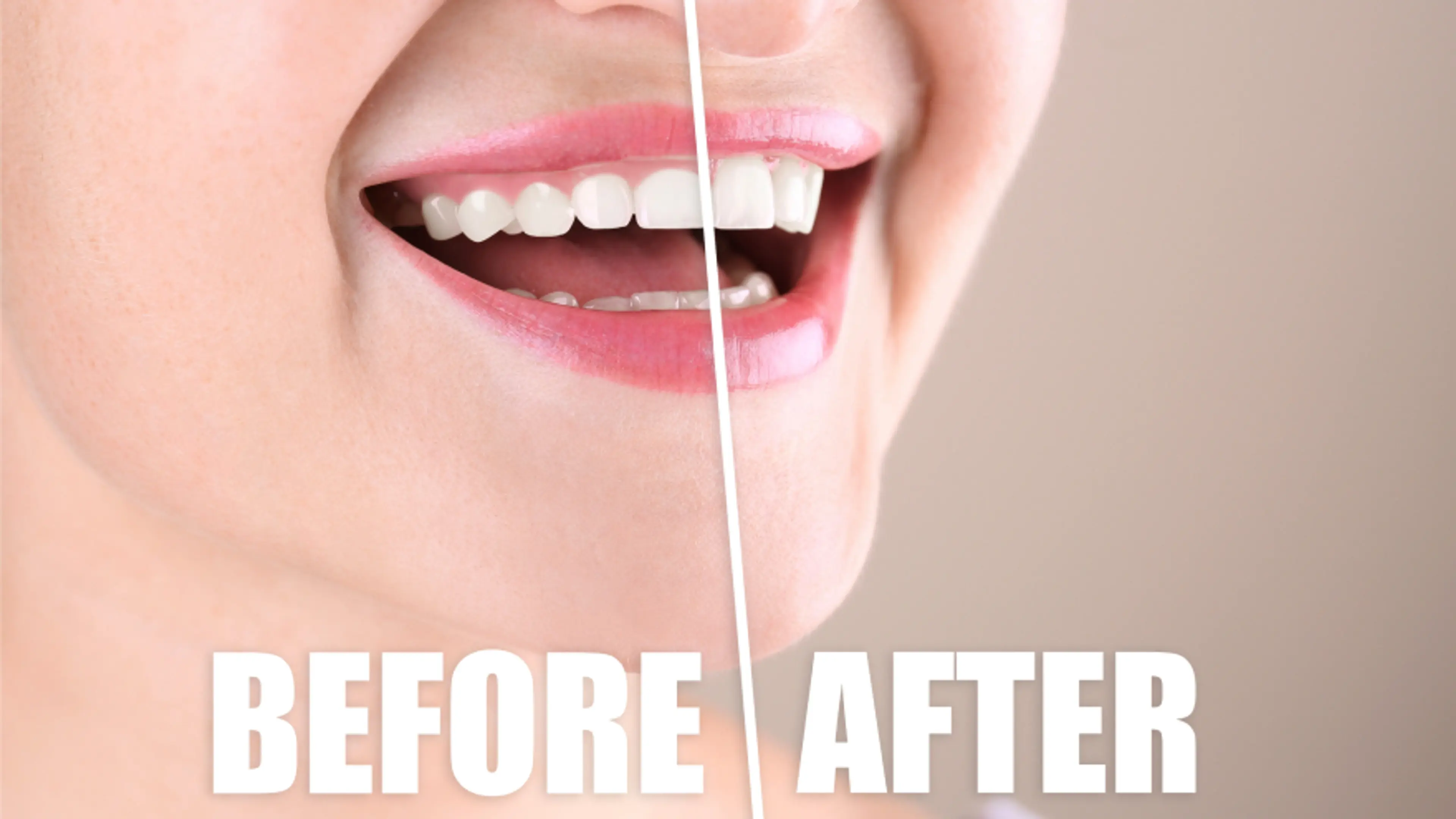 การรักษายิ้มเห็นเหงือก