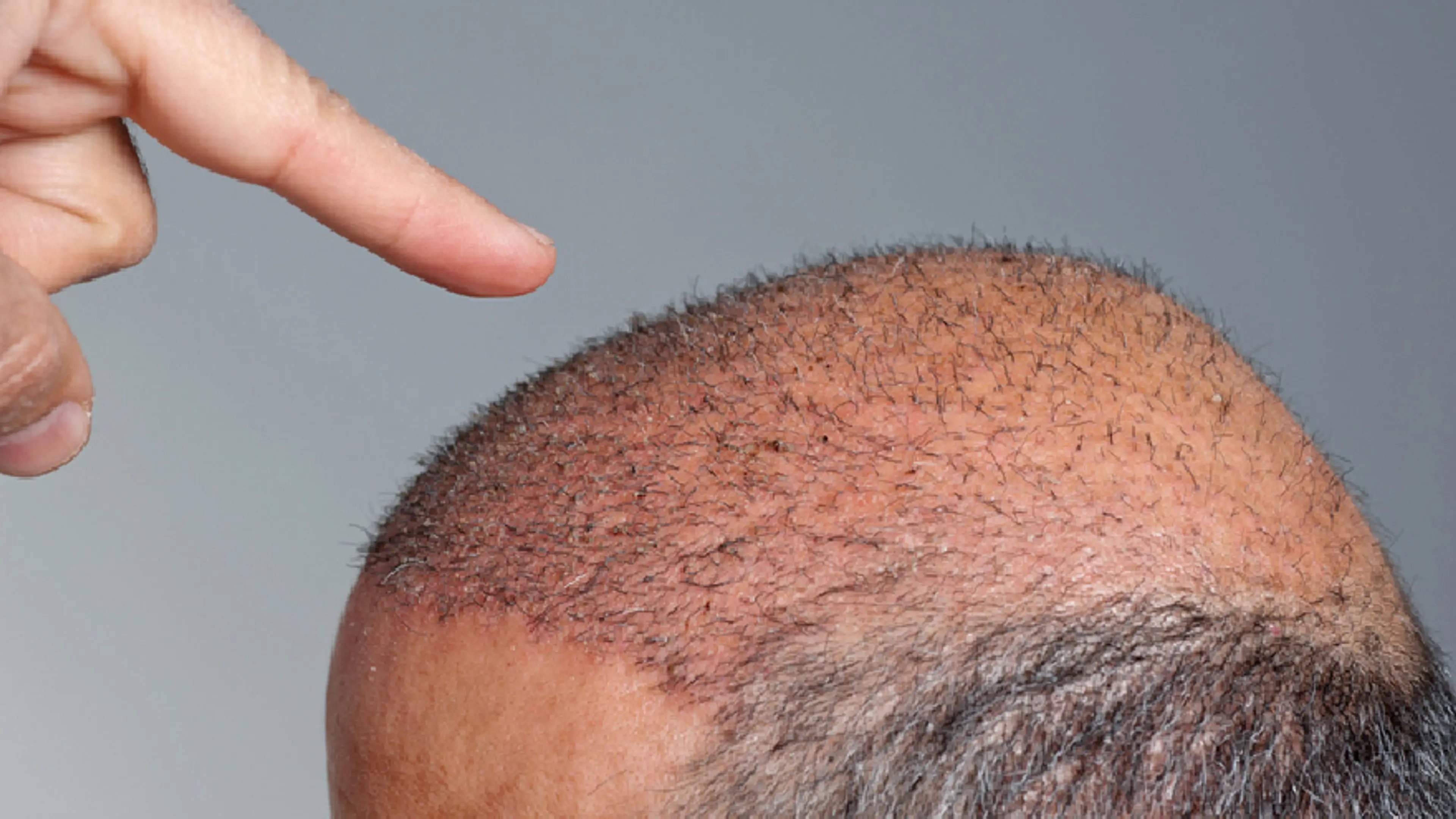 hair transplant