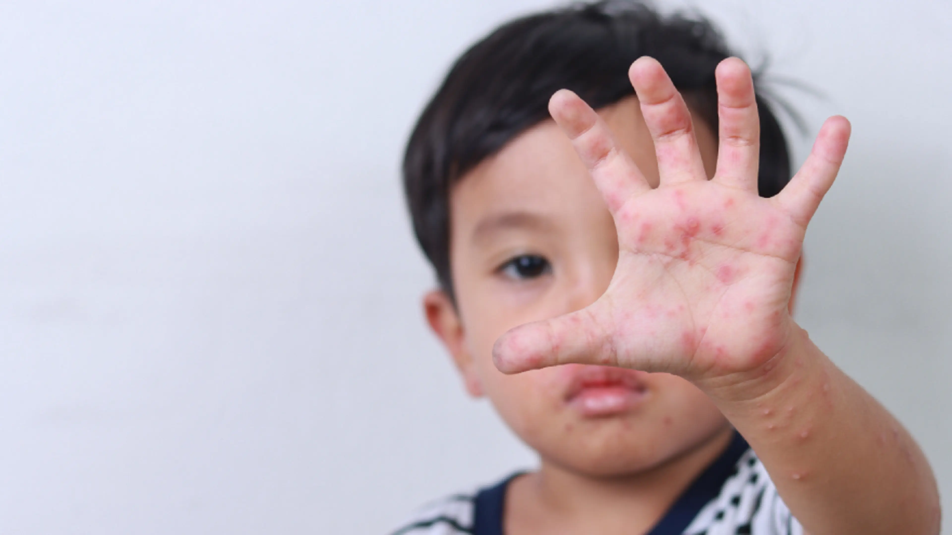 Hand, Foot, and Mouth Disease