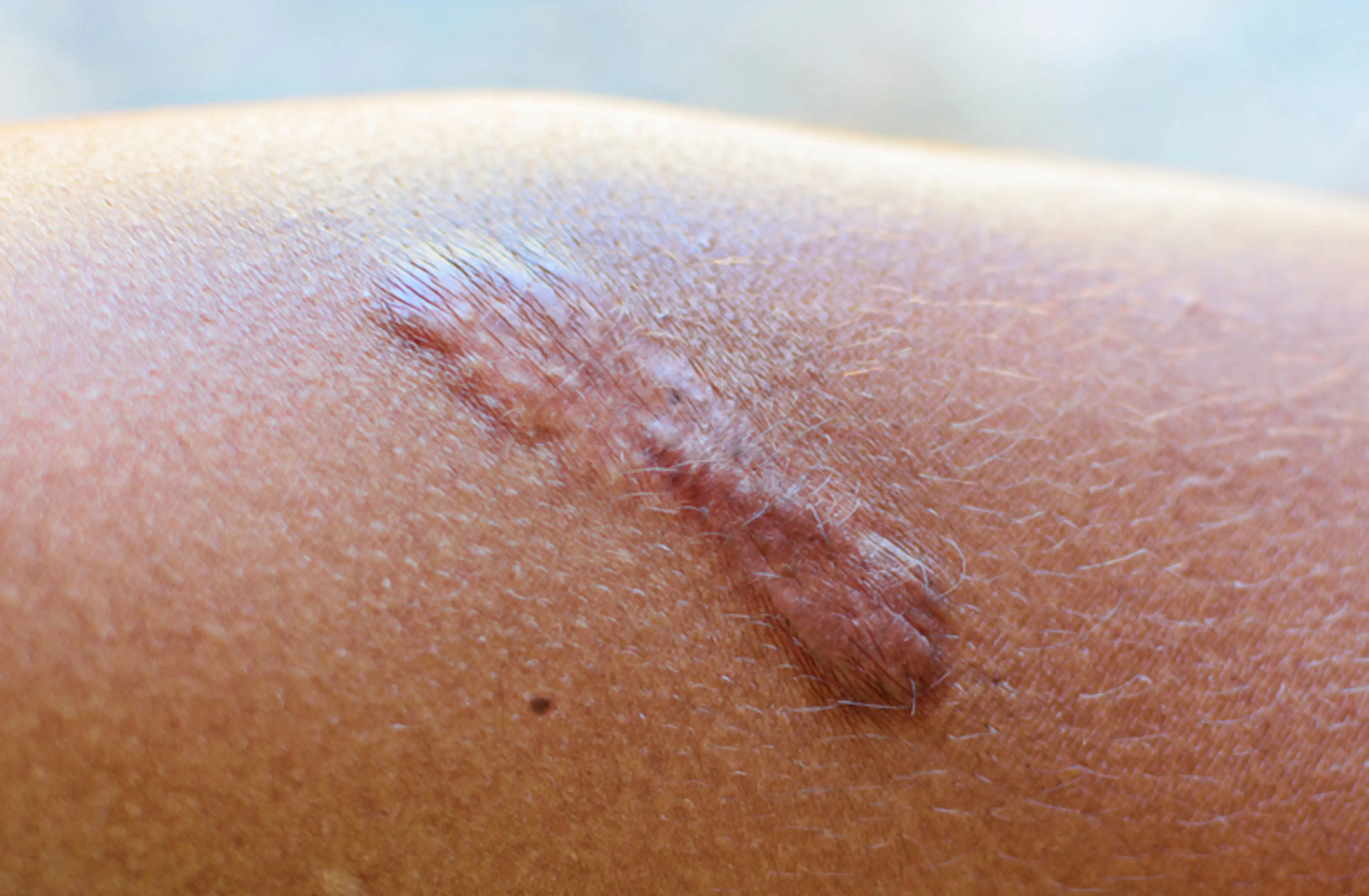 增生性瘢痕和瘢痕疙瘩