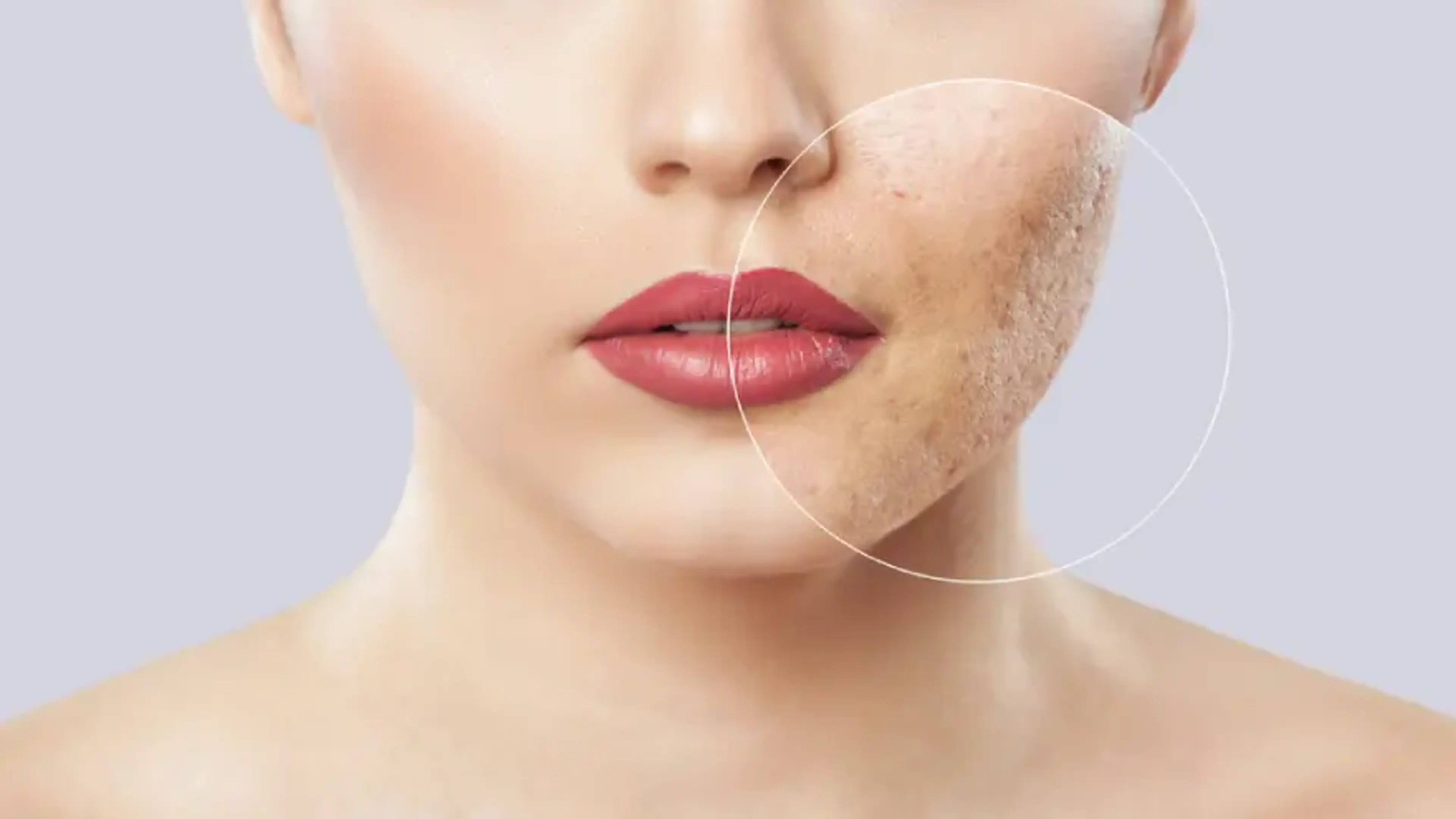Enlarged Pores