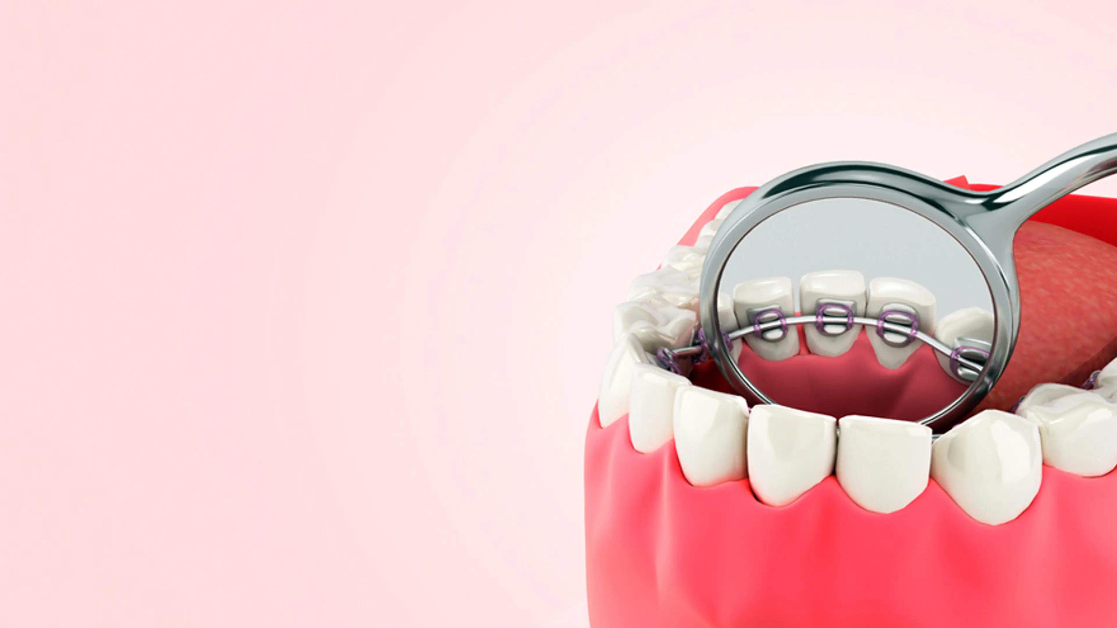 What Are Lingual Braces