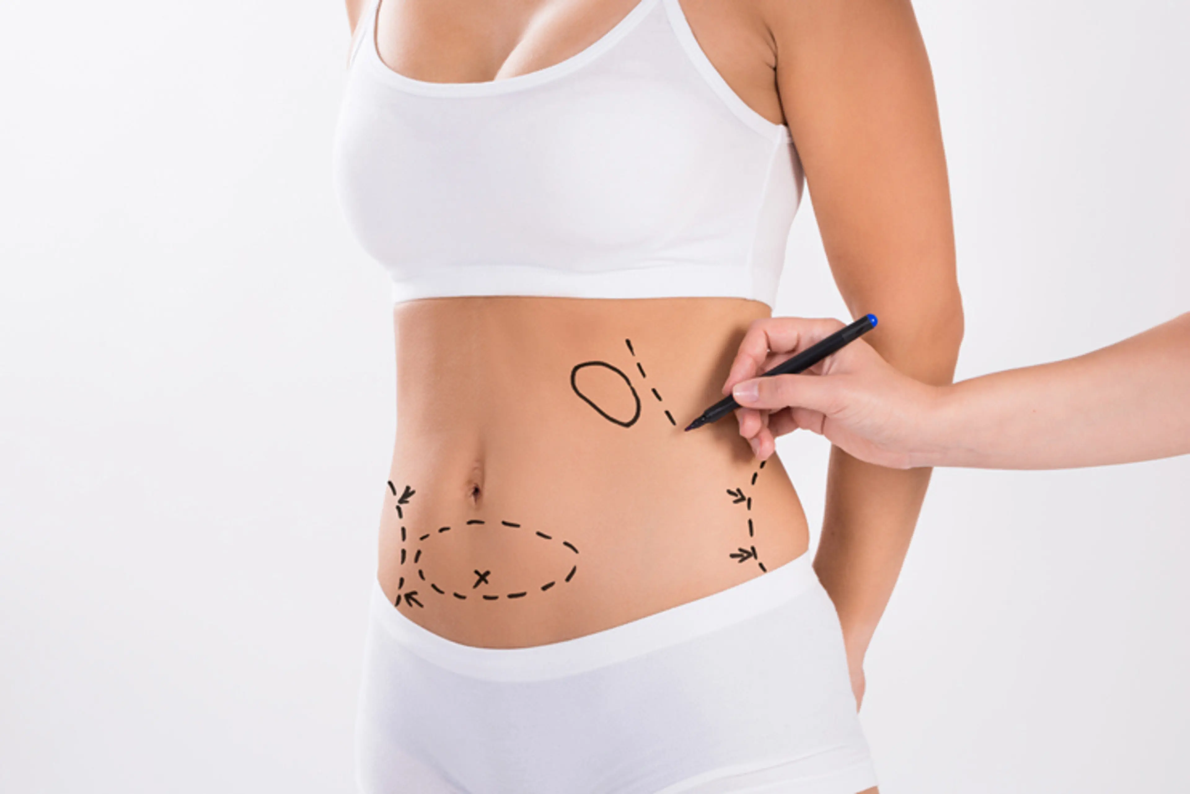 Slim Patients Consider Liposuction