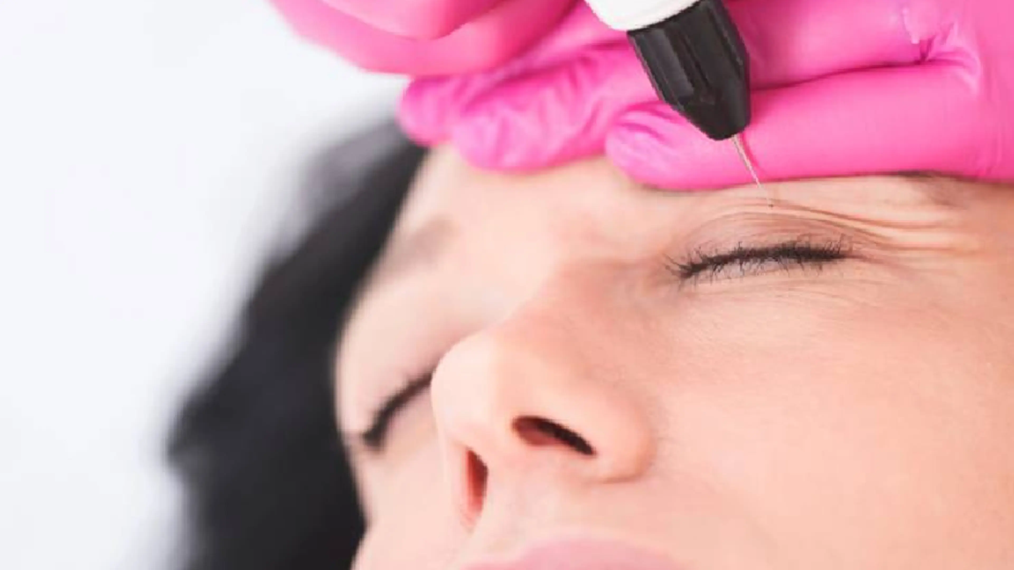 Minimally Invasive Double Eyelid Surgery