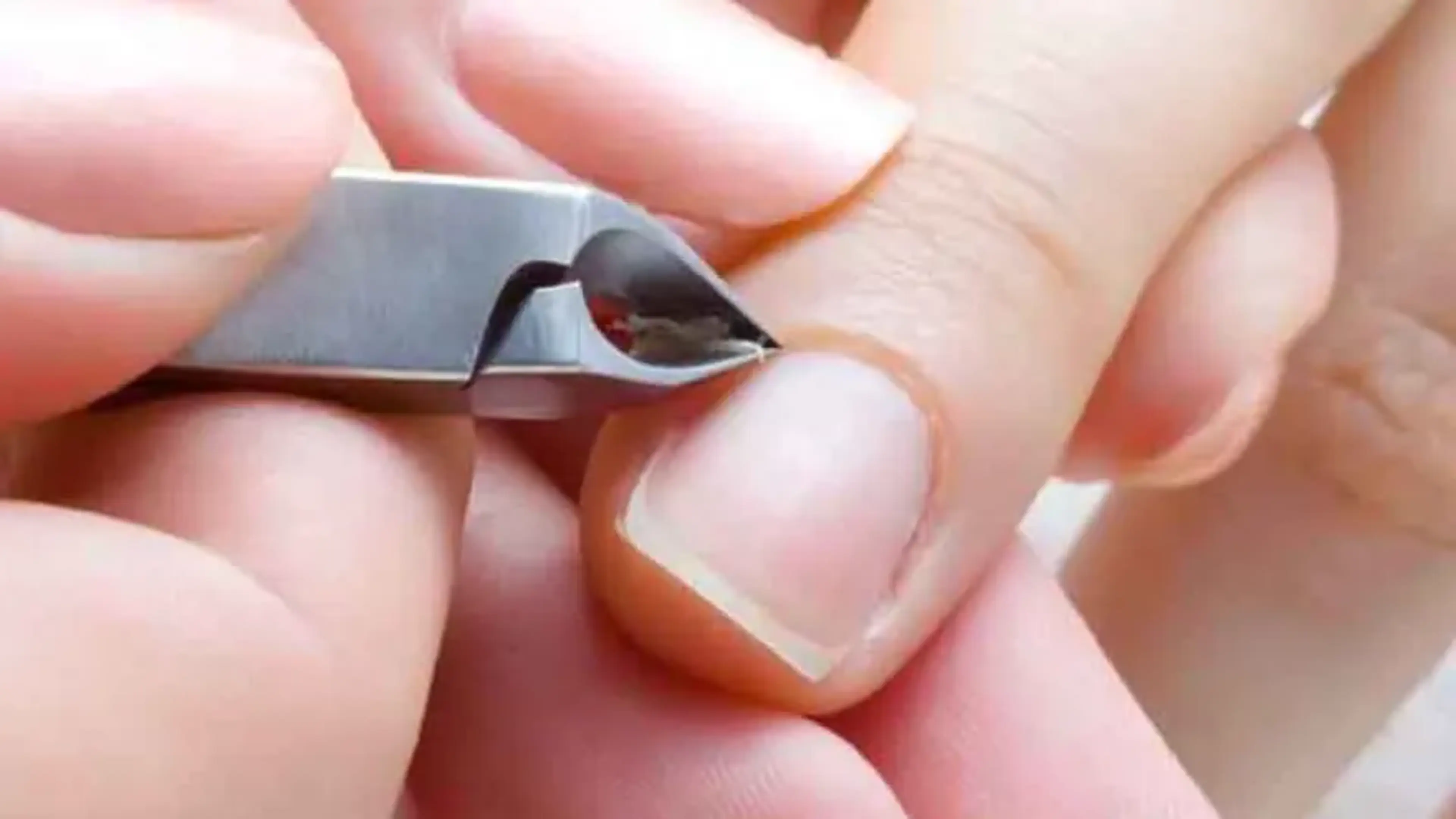 nail disorders