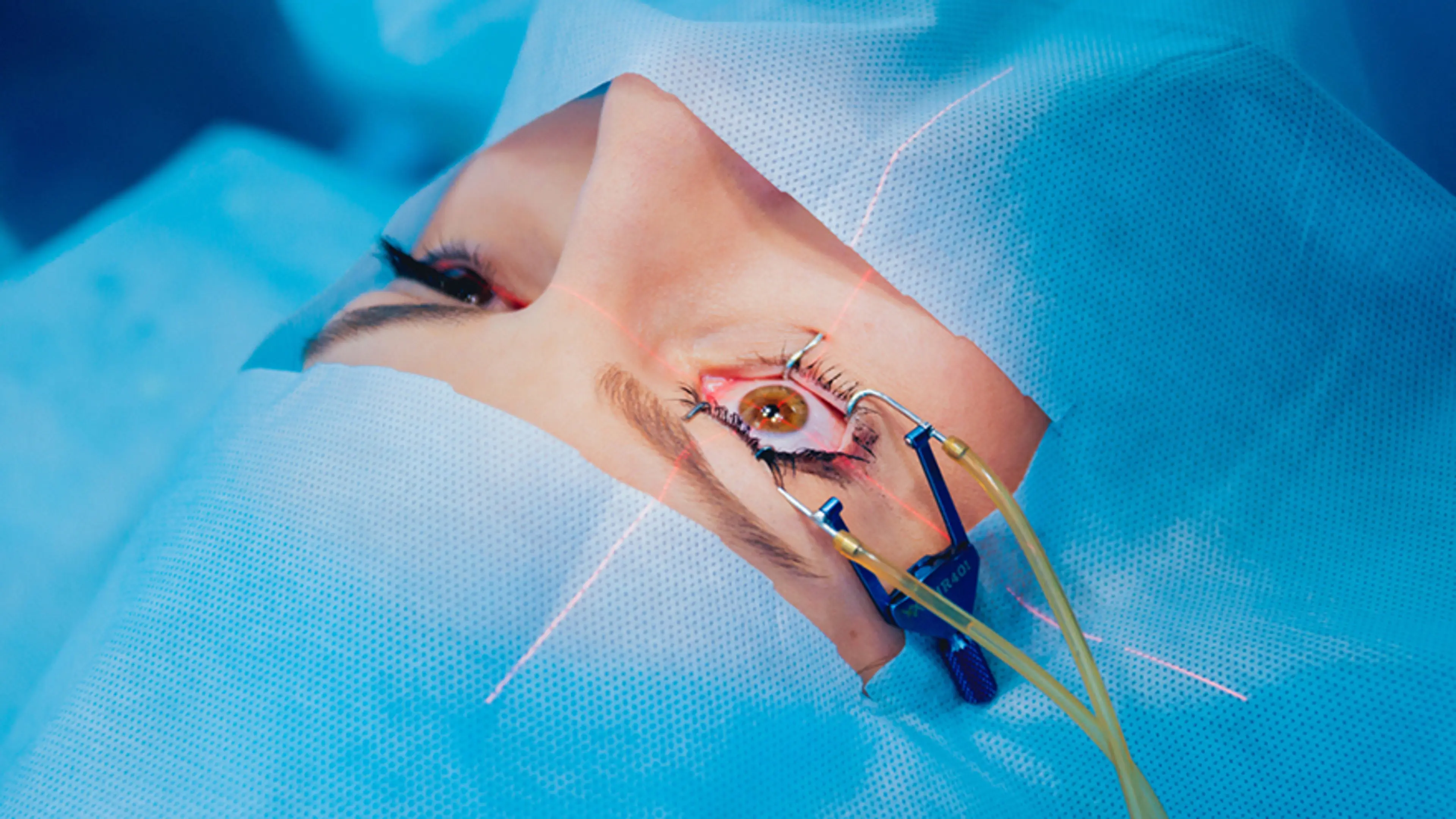 A patient undergoing laser vision correction surgery with the eye stabilized by a surgical device, illustrating advanced refractive eye surgery designed to correct vision by addressing the eye’s optical structure.