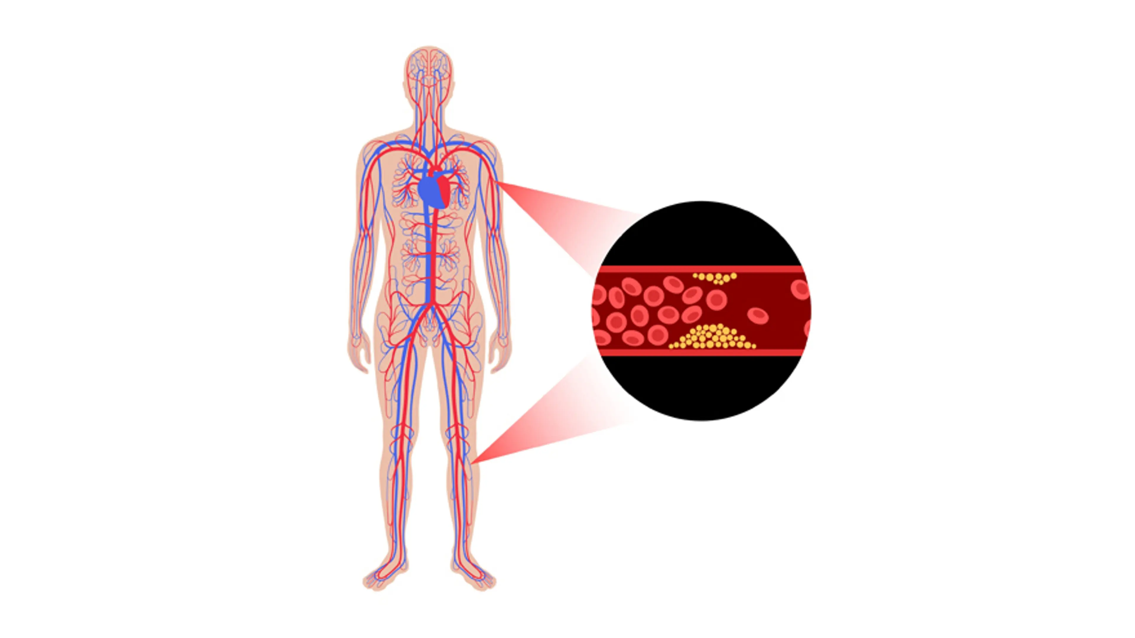 Stem Cells for Peripheral Circulation: A Non-Invasive Solution