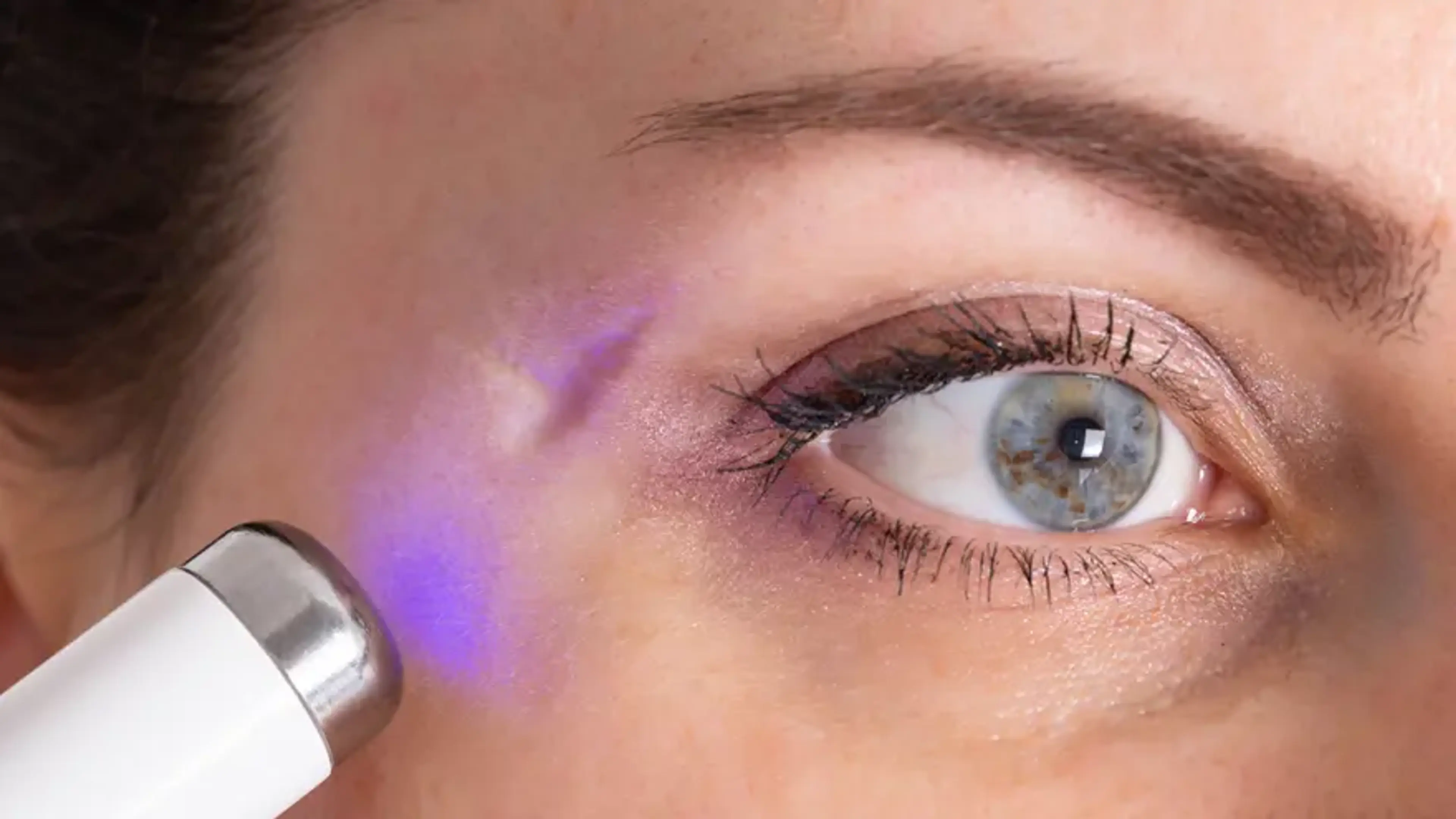 Close-up of a woman receiving targeted laser treatment near the eye area to reduce the appearance of a facial scar and improve skin texture.