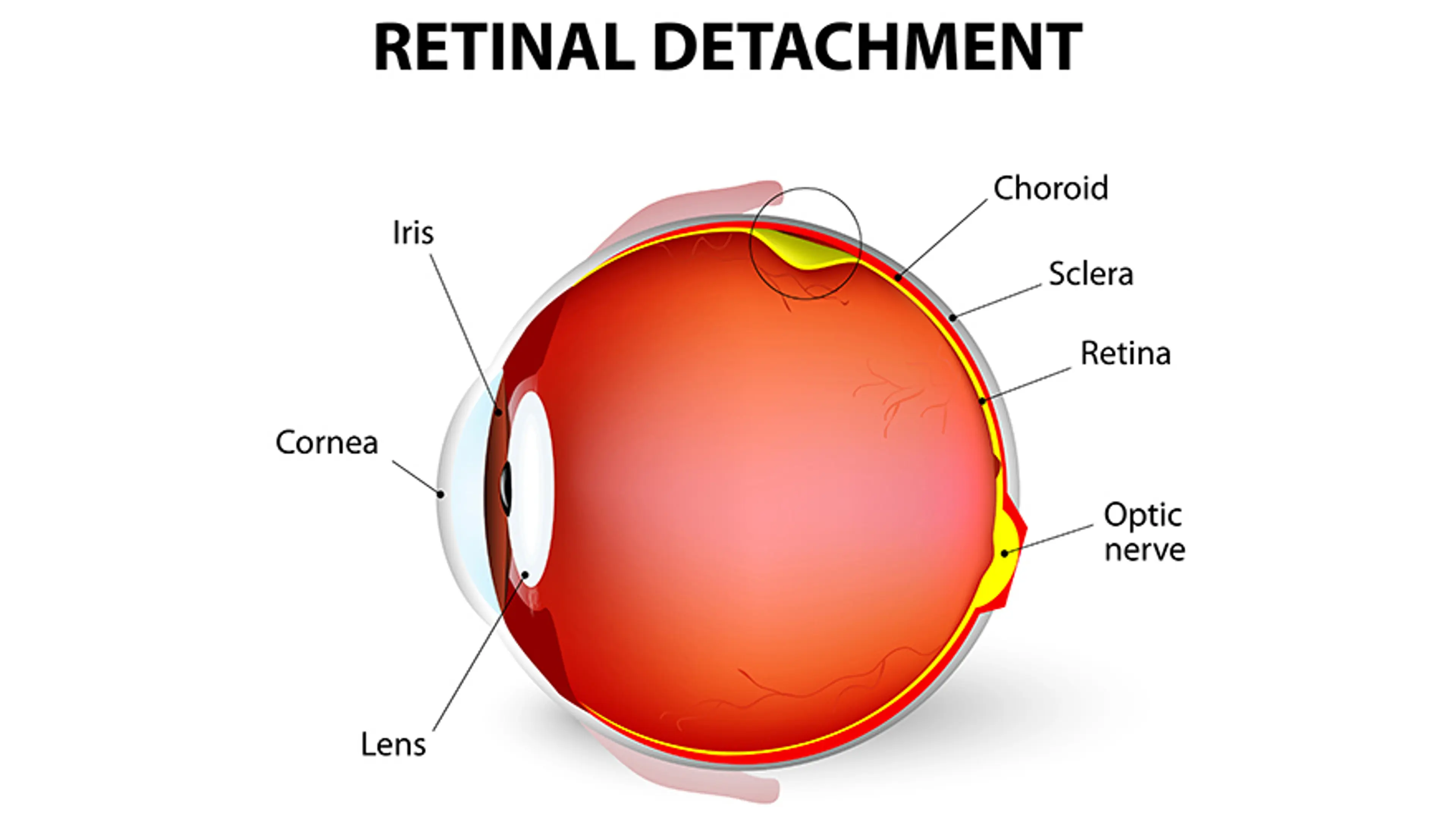 Detached Retina