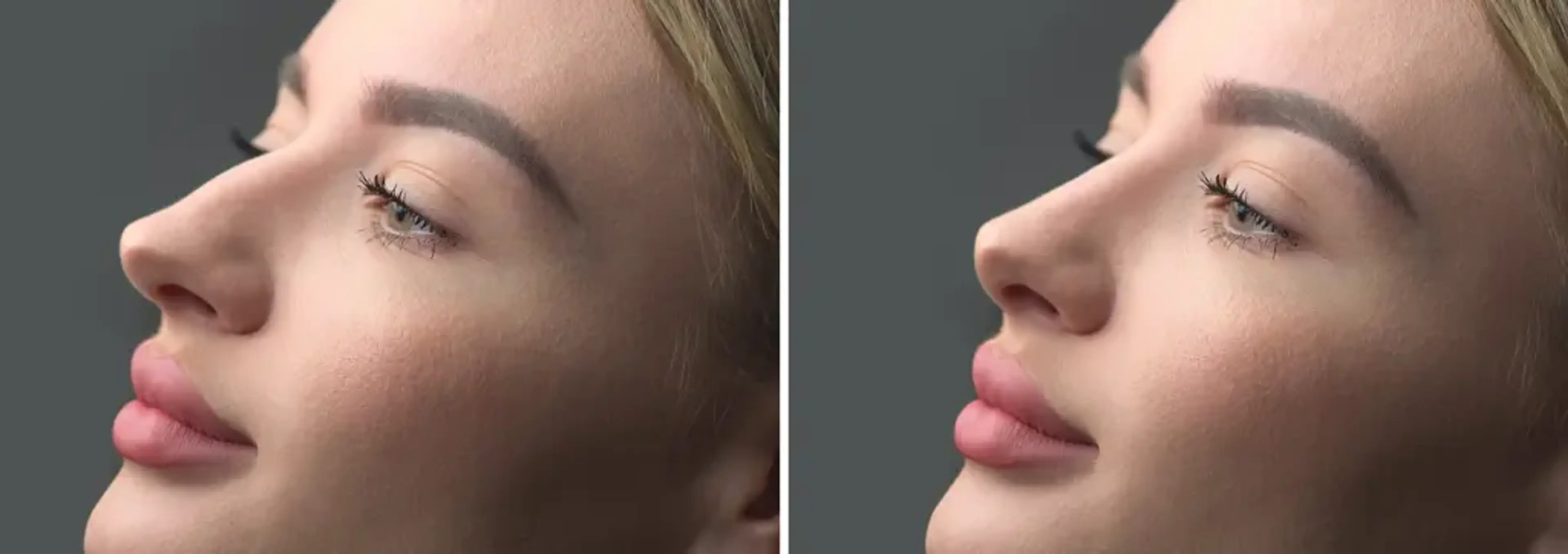 1mm Plastic Surgery
