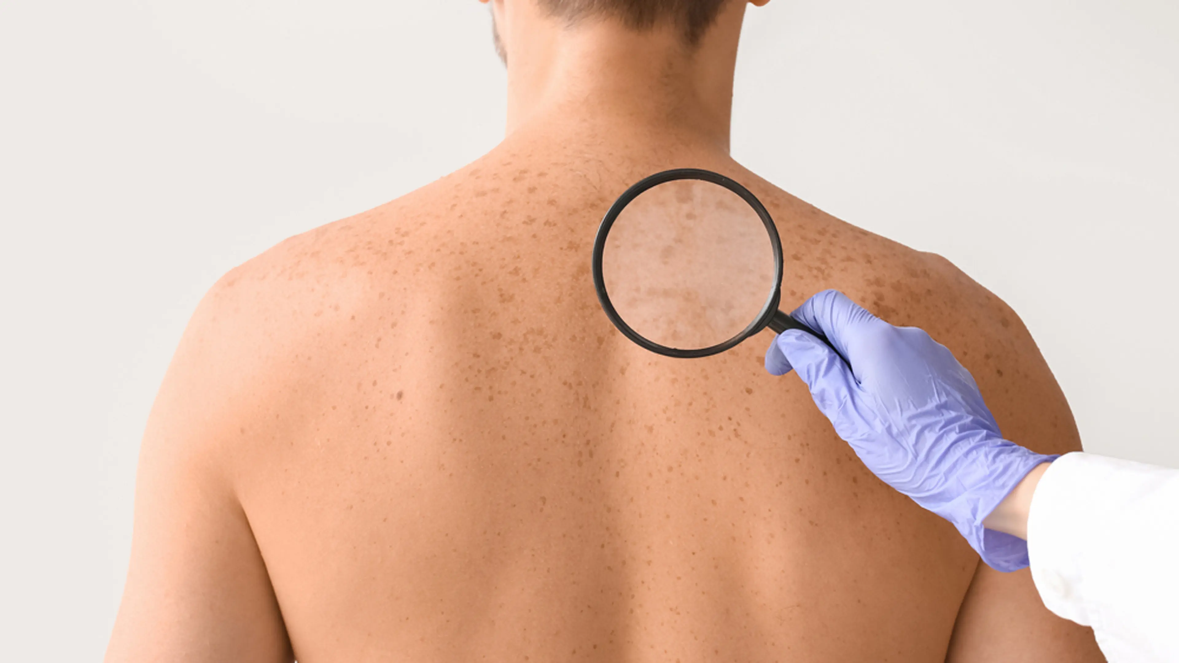 How to Treat Sunspots Effectively and Restore Even Skin Tone