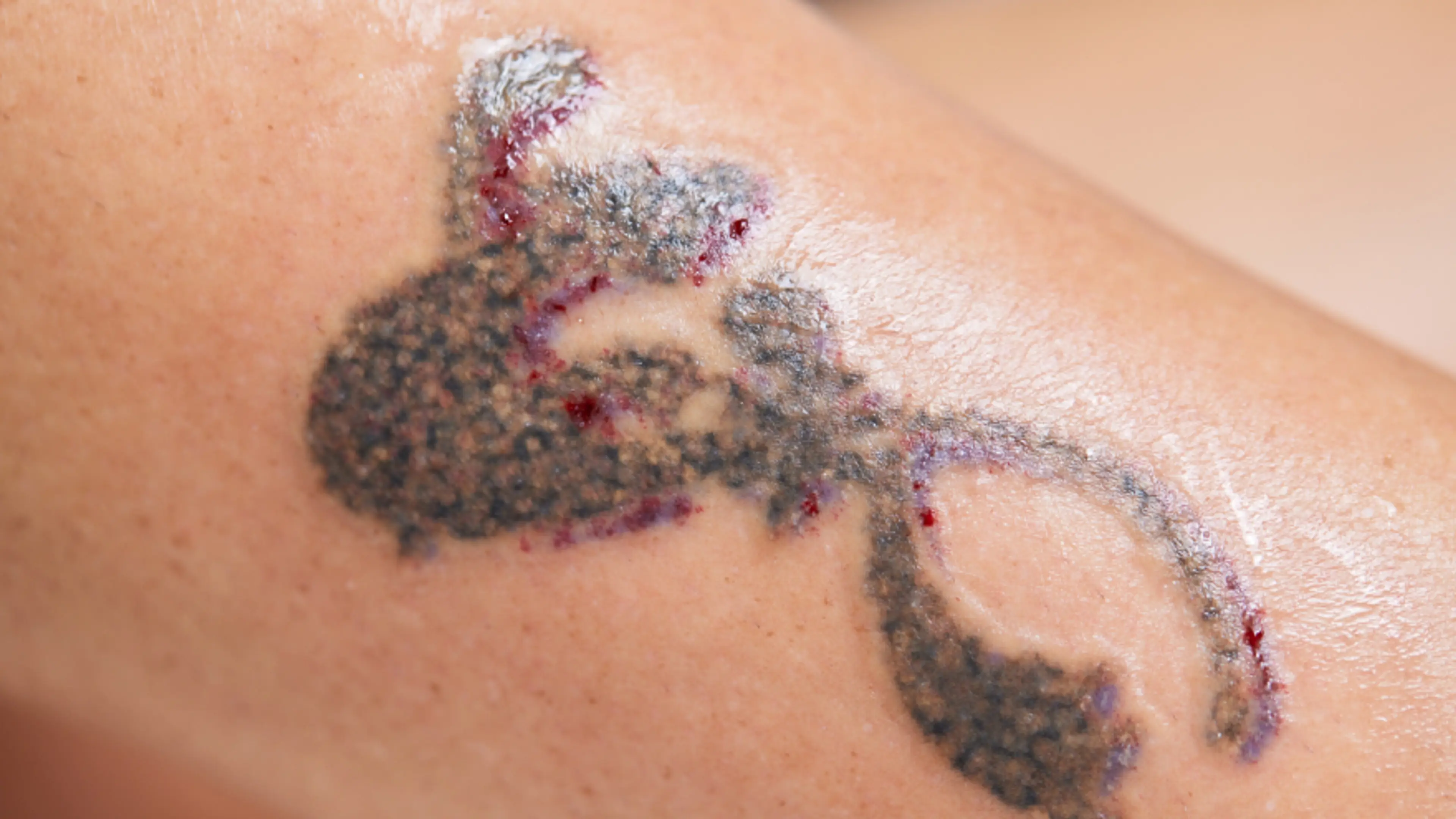 Tattoo Removal Options