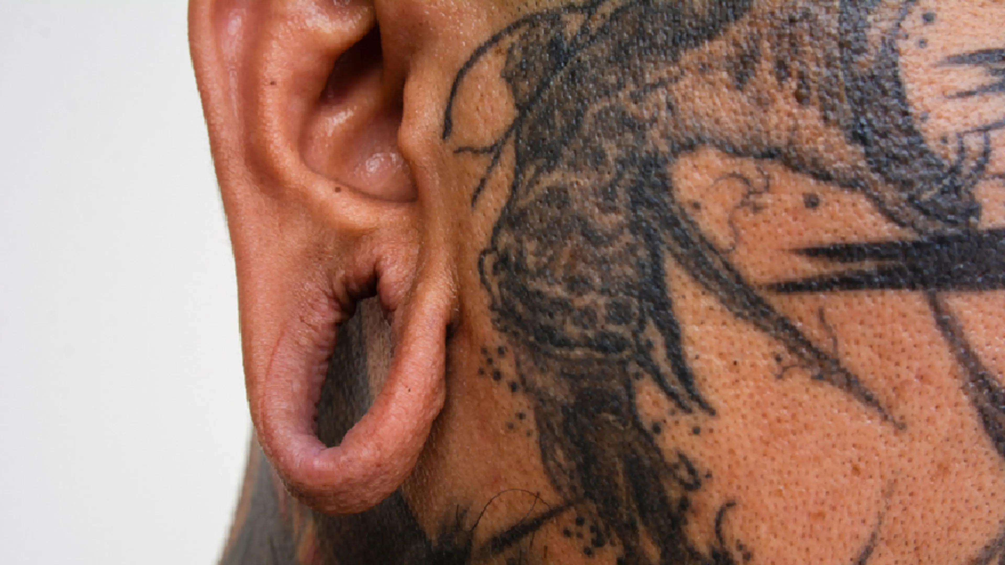 Tattoo Removal