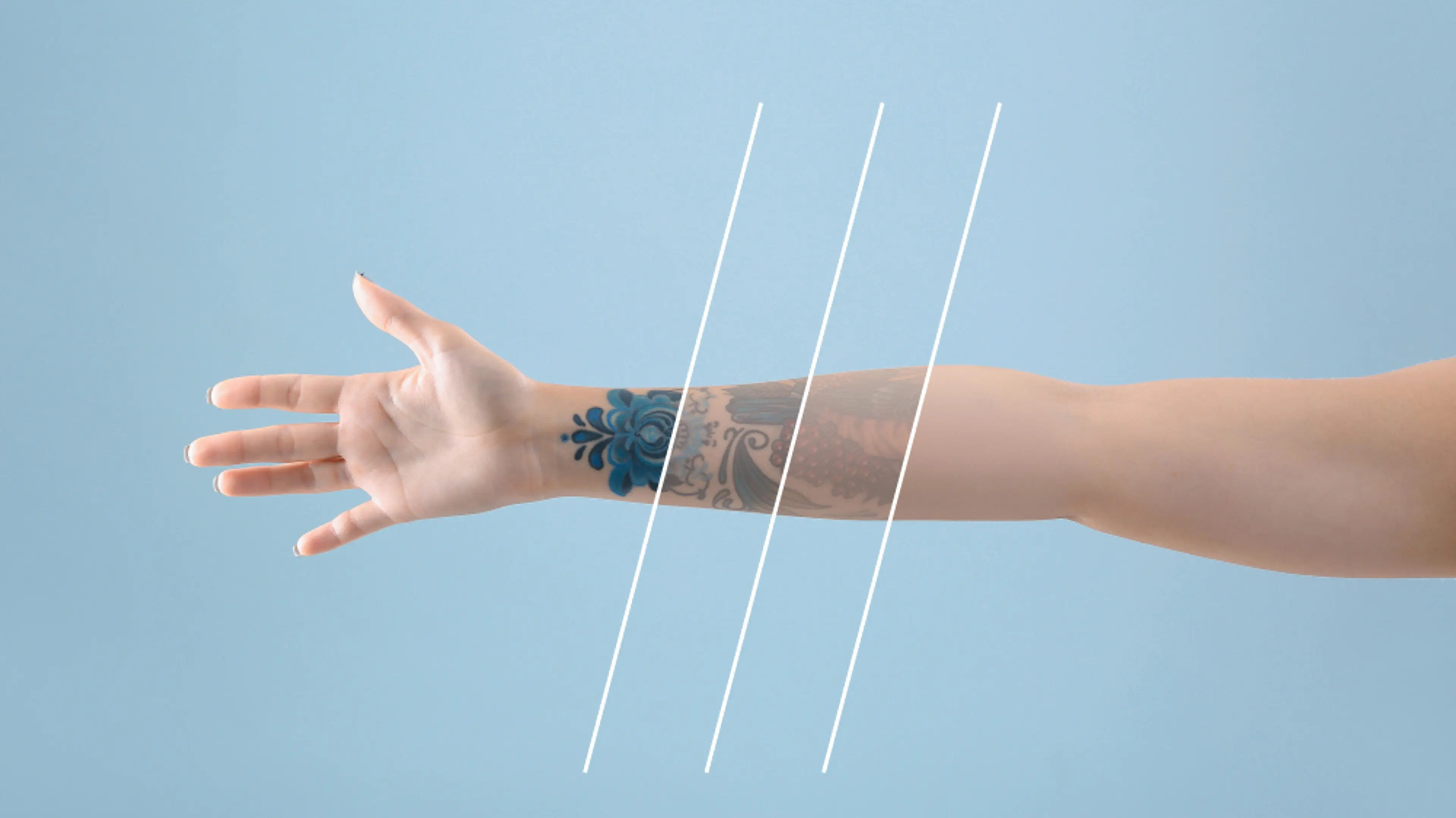 Tattoo Removal with Laser Technology
