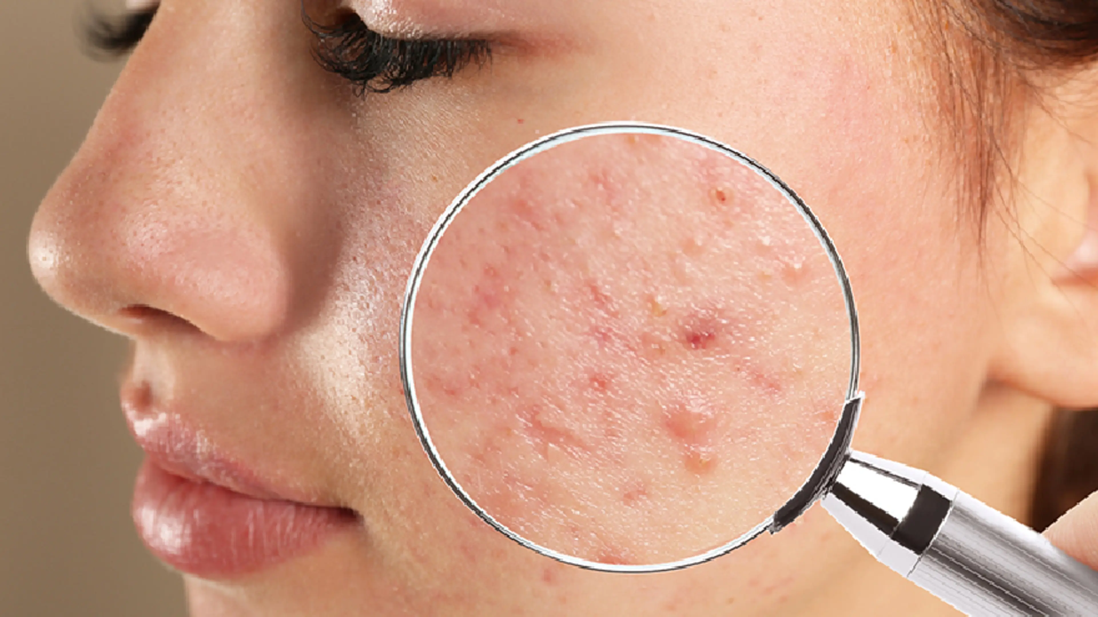teen acne