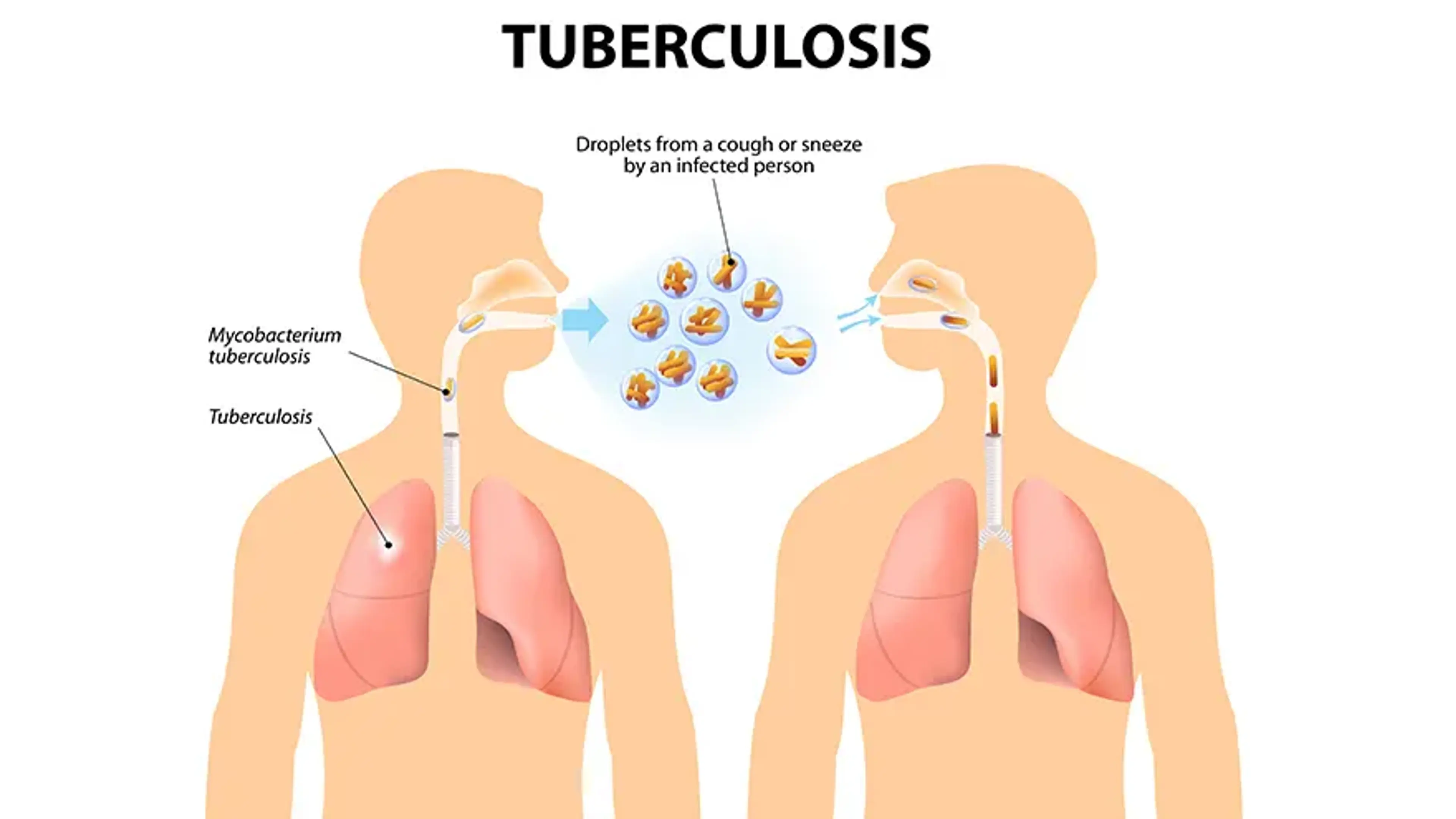 Articles | Tuberculosis: Breaking the Chain of Transmission