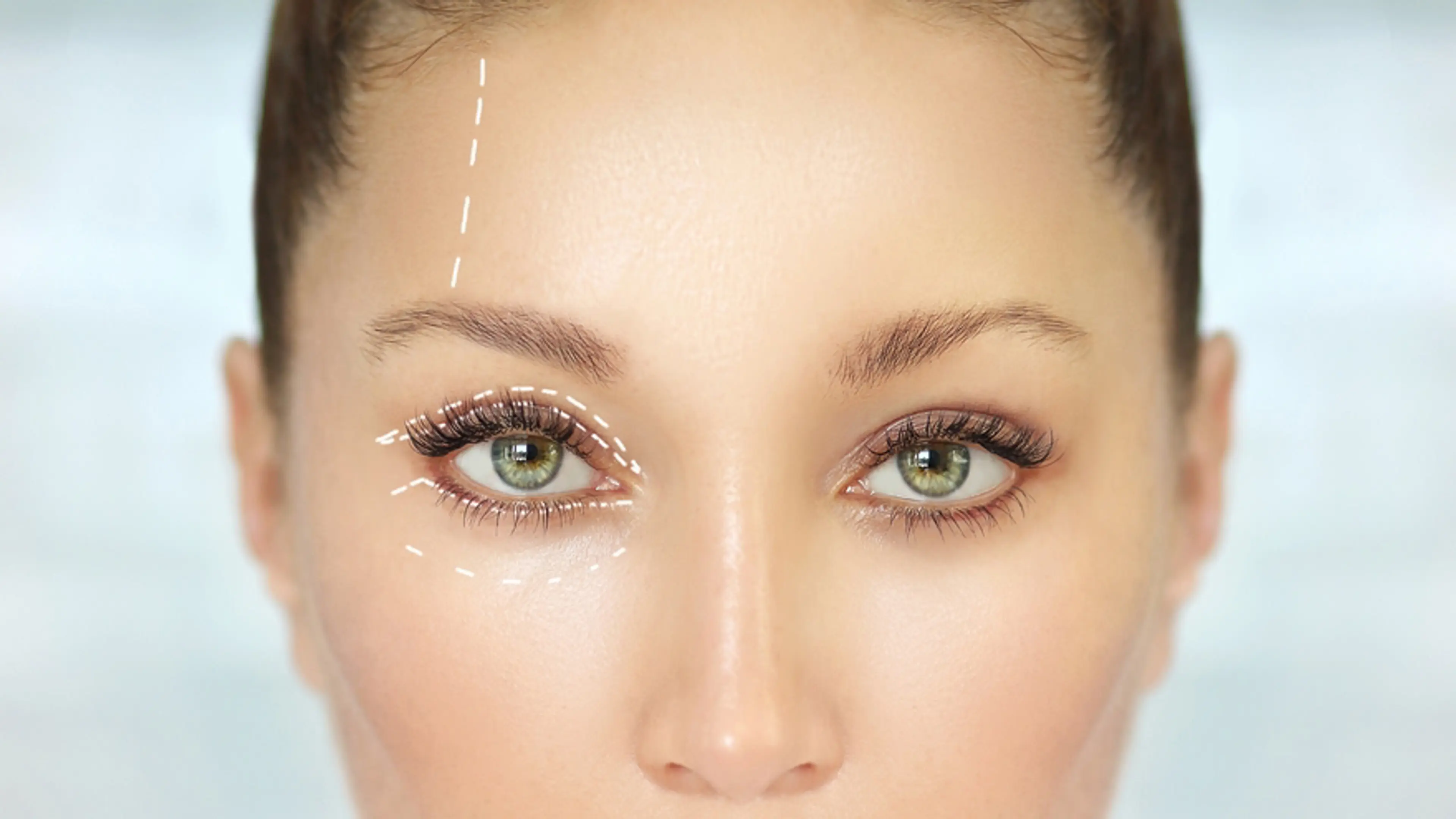 Upper Eyelid Surgery