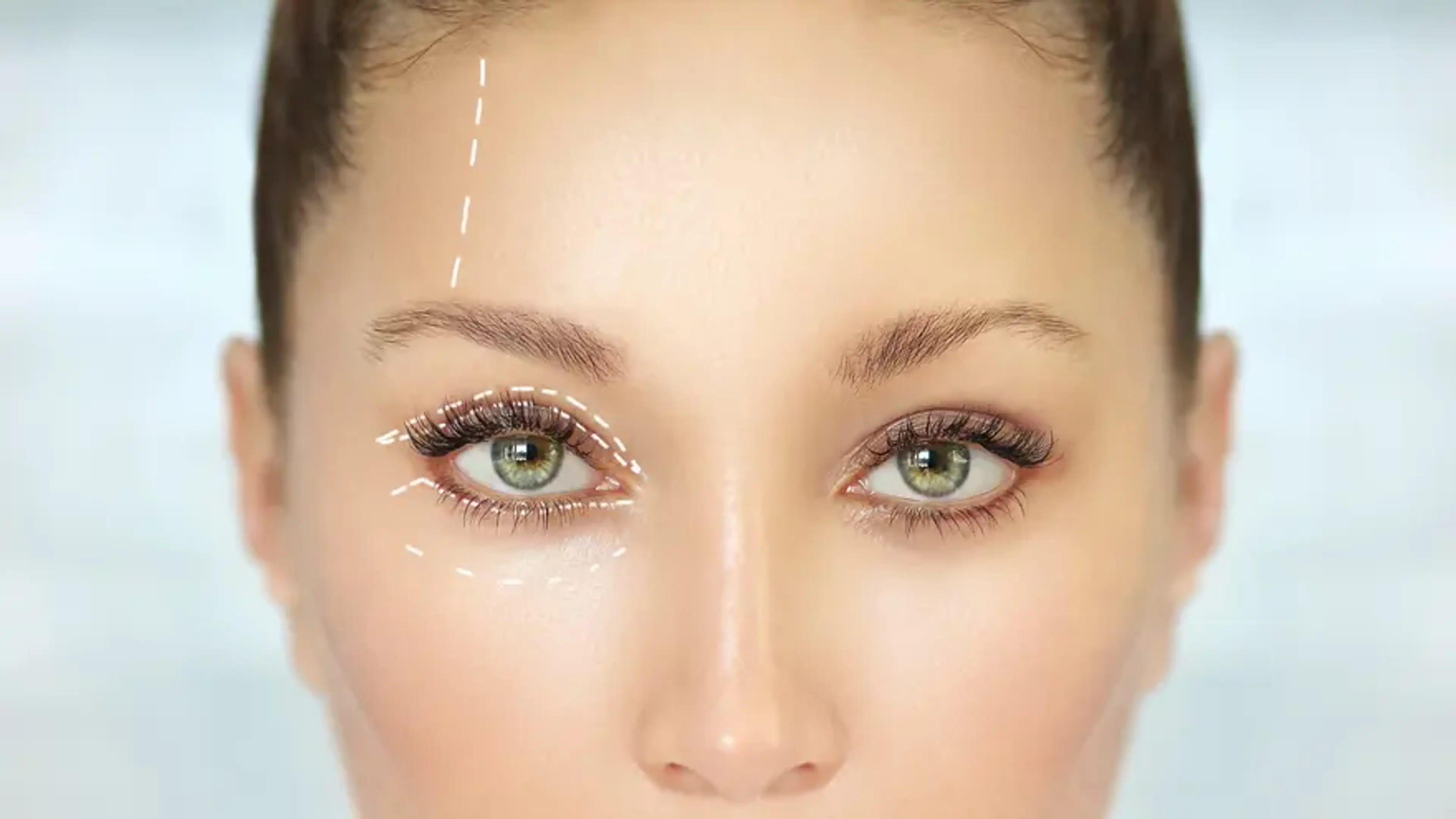 Close-up of a woman's eyes with cosmetic guideline markings around the upper and lower eyelids, illustrating areas for potential upper eyelid enhancement or treatment.