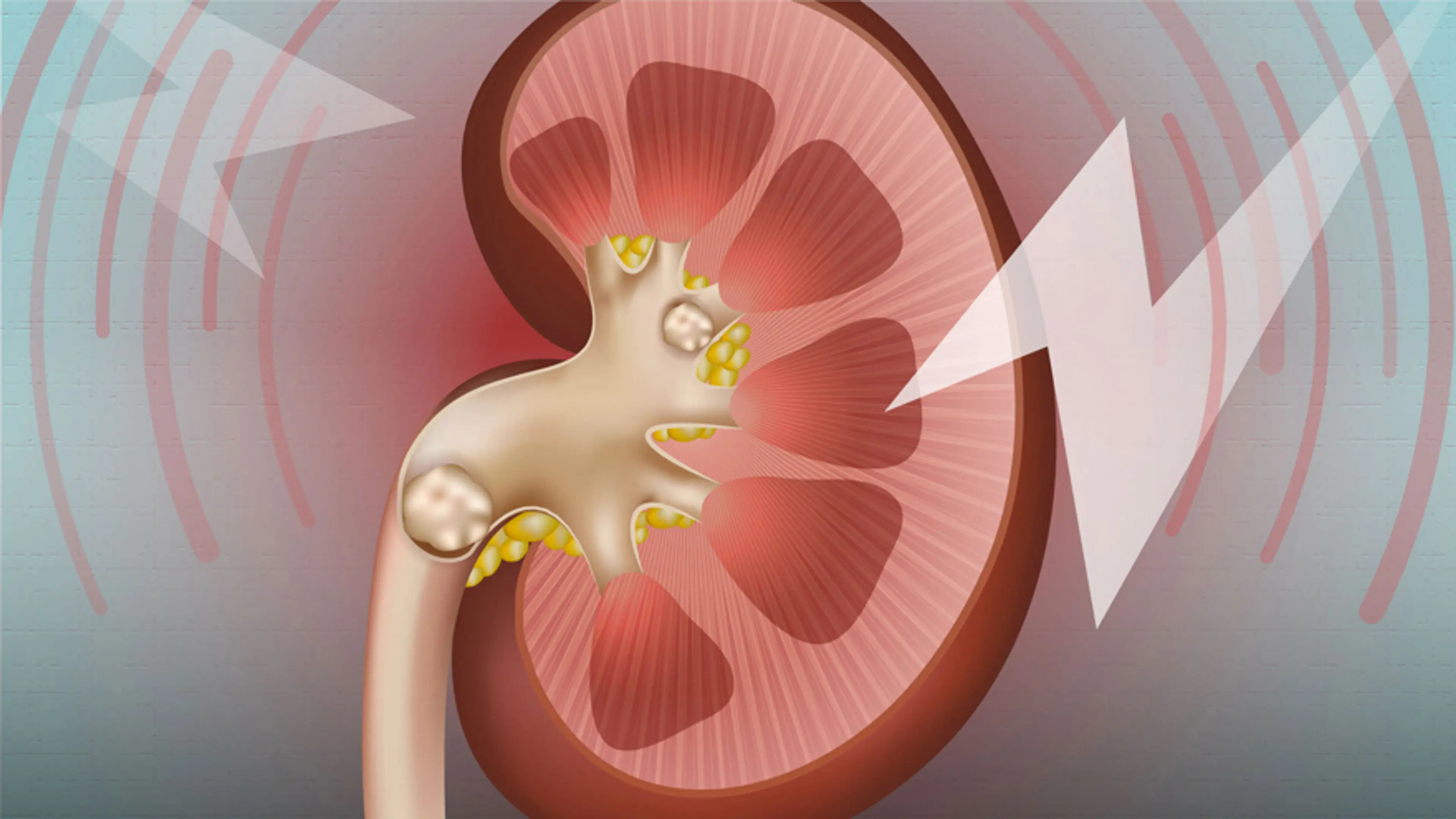 What Causes Urinary Stones and How to Prevent Them Naturally