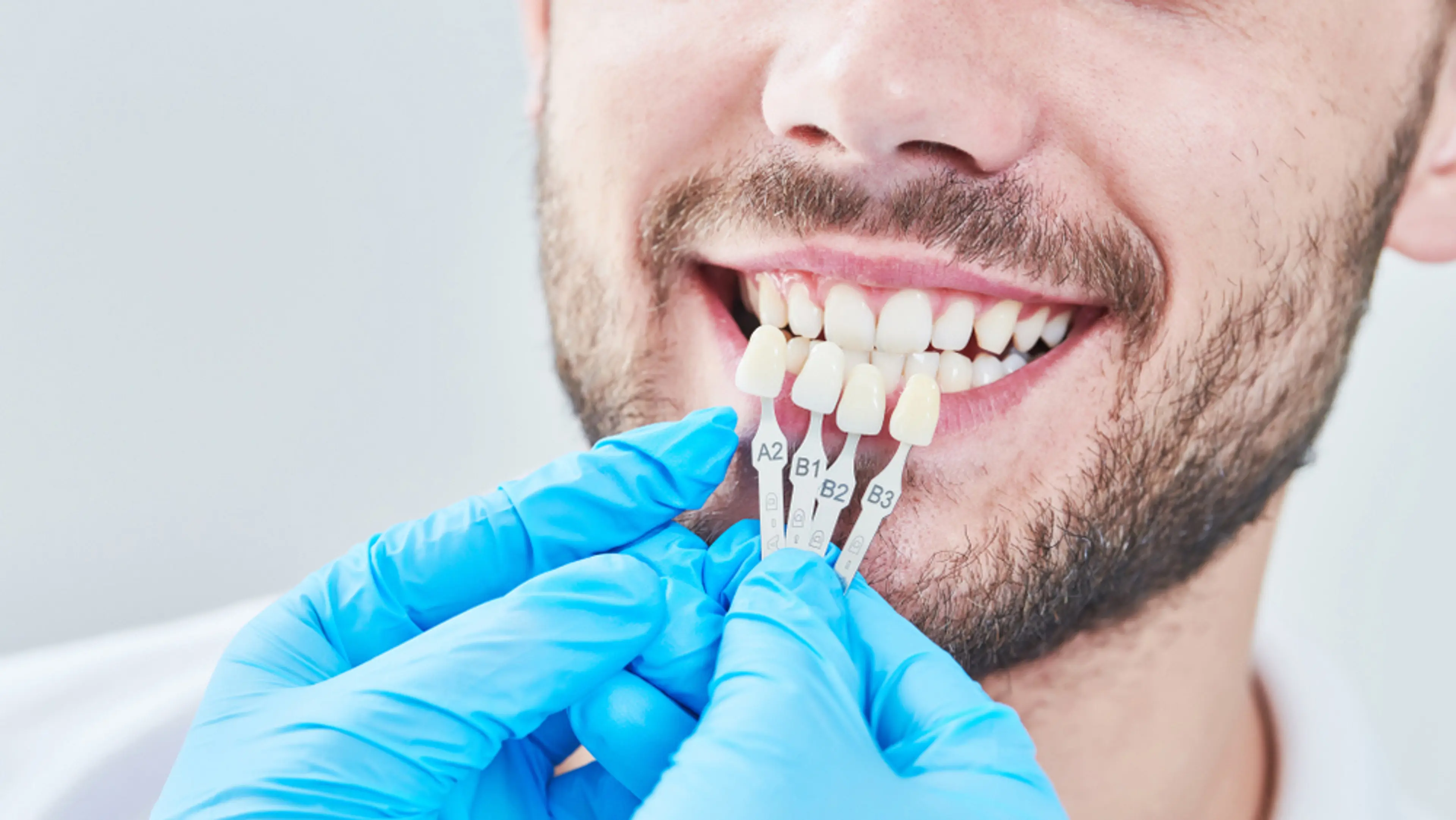 Shade for Veneers
