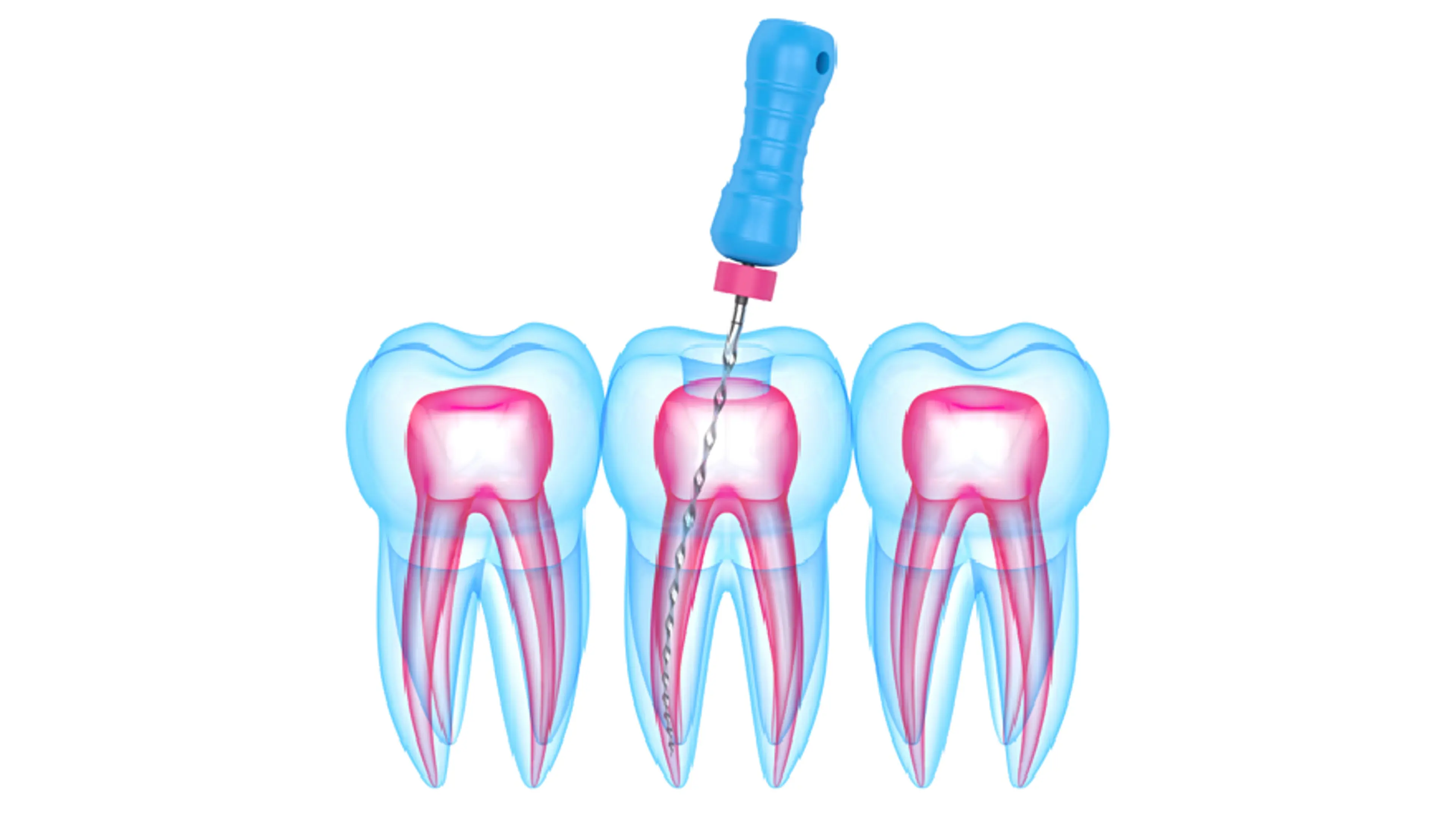 What to Expect During Root Canal Treatment and Recovery