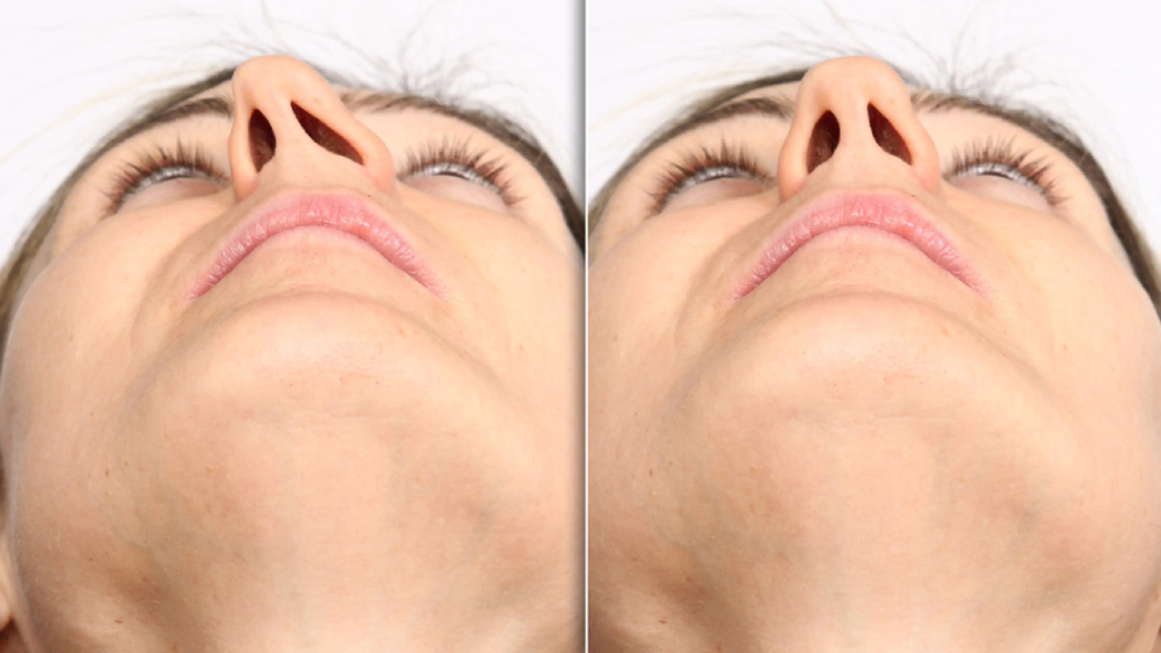 deviated septum