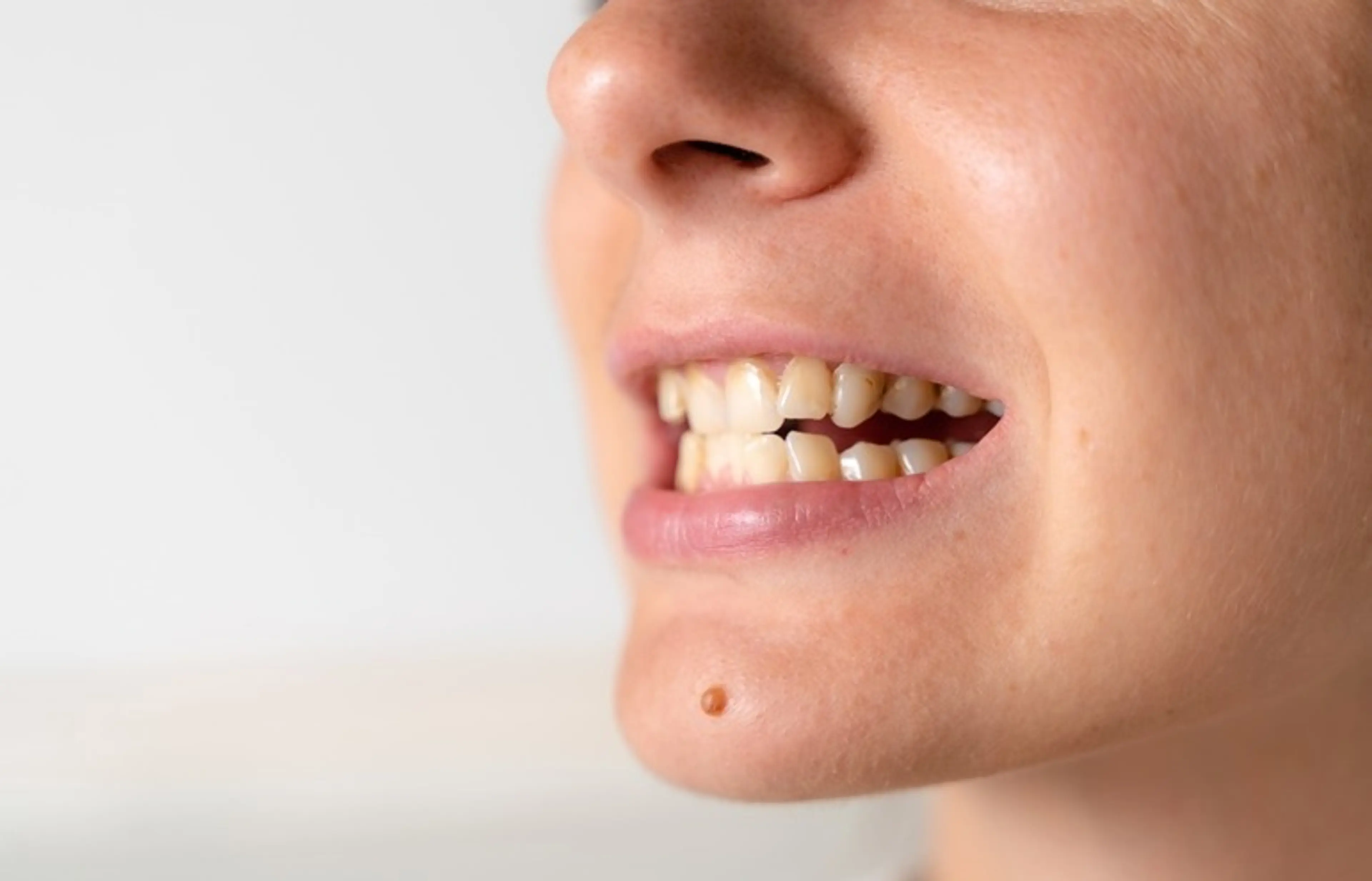 Dental Crowding