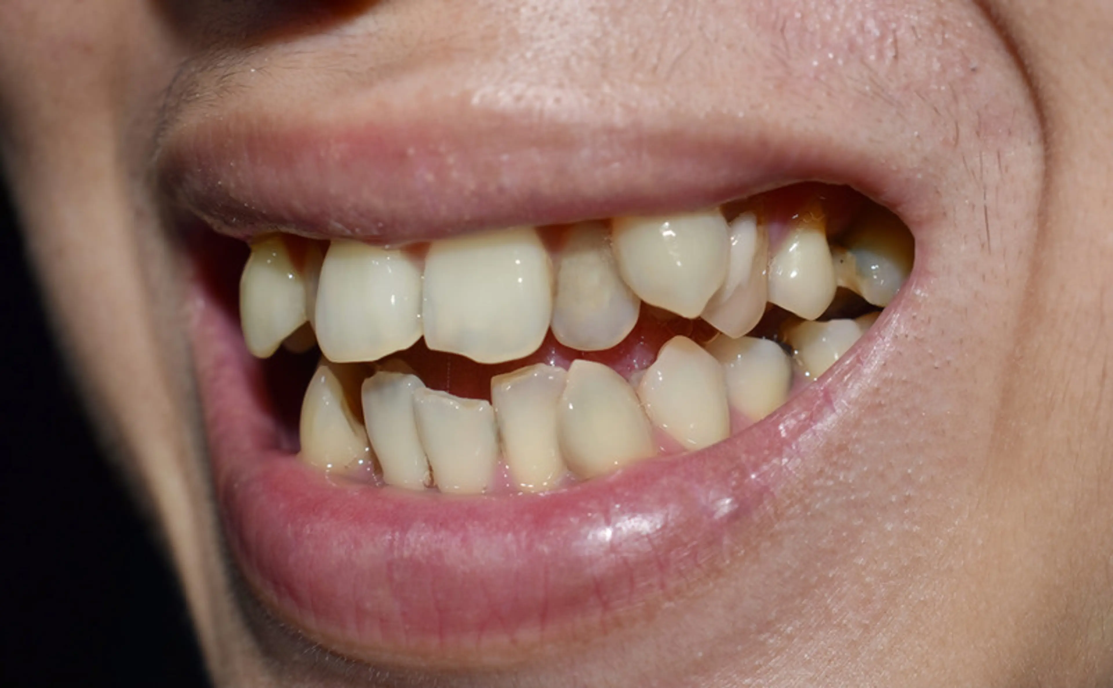 Dental Crowding