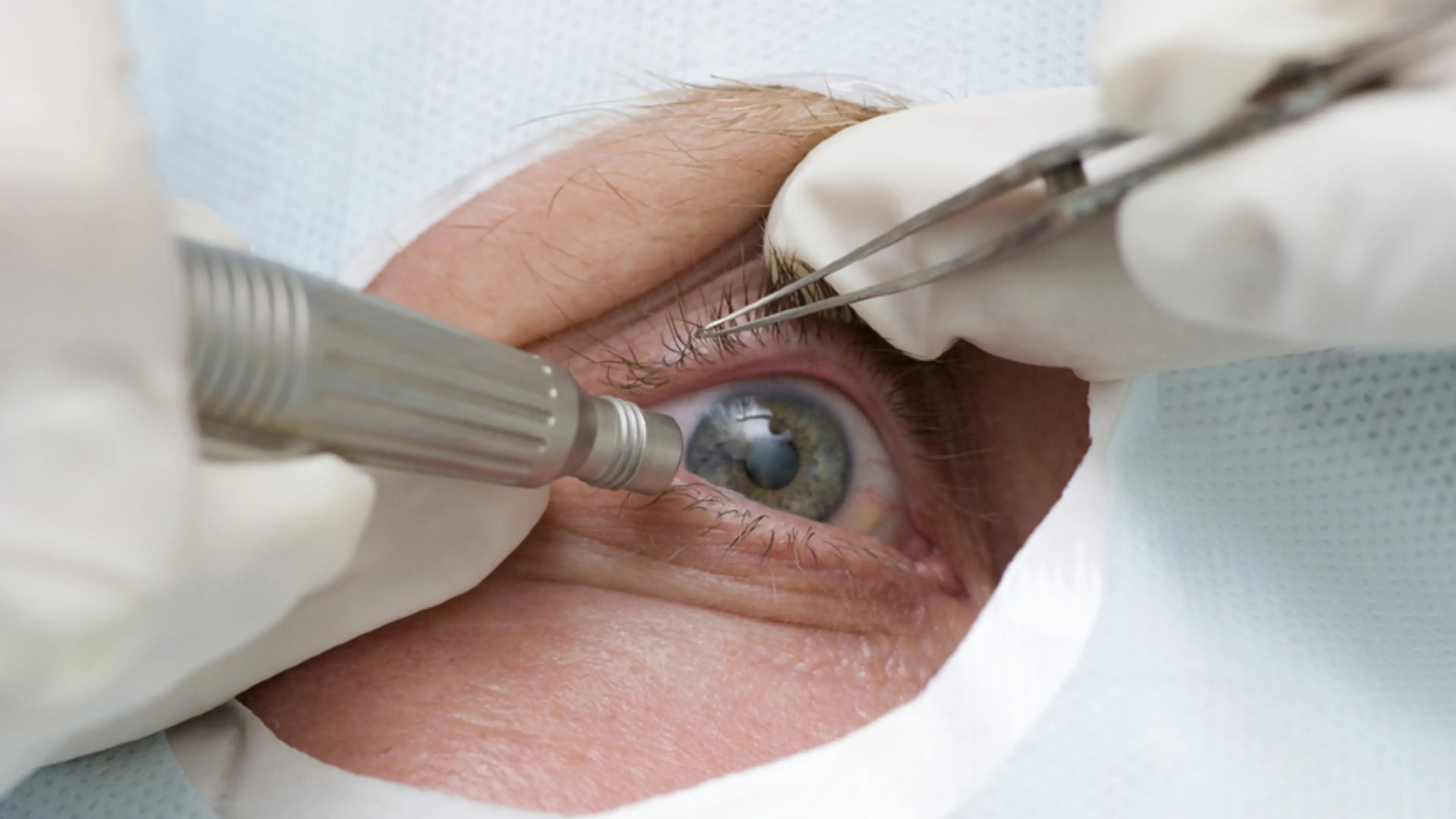 Ultrasound Multifocal Cataract