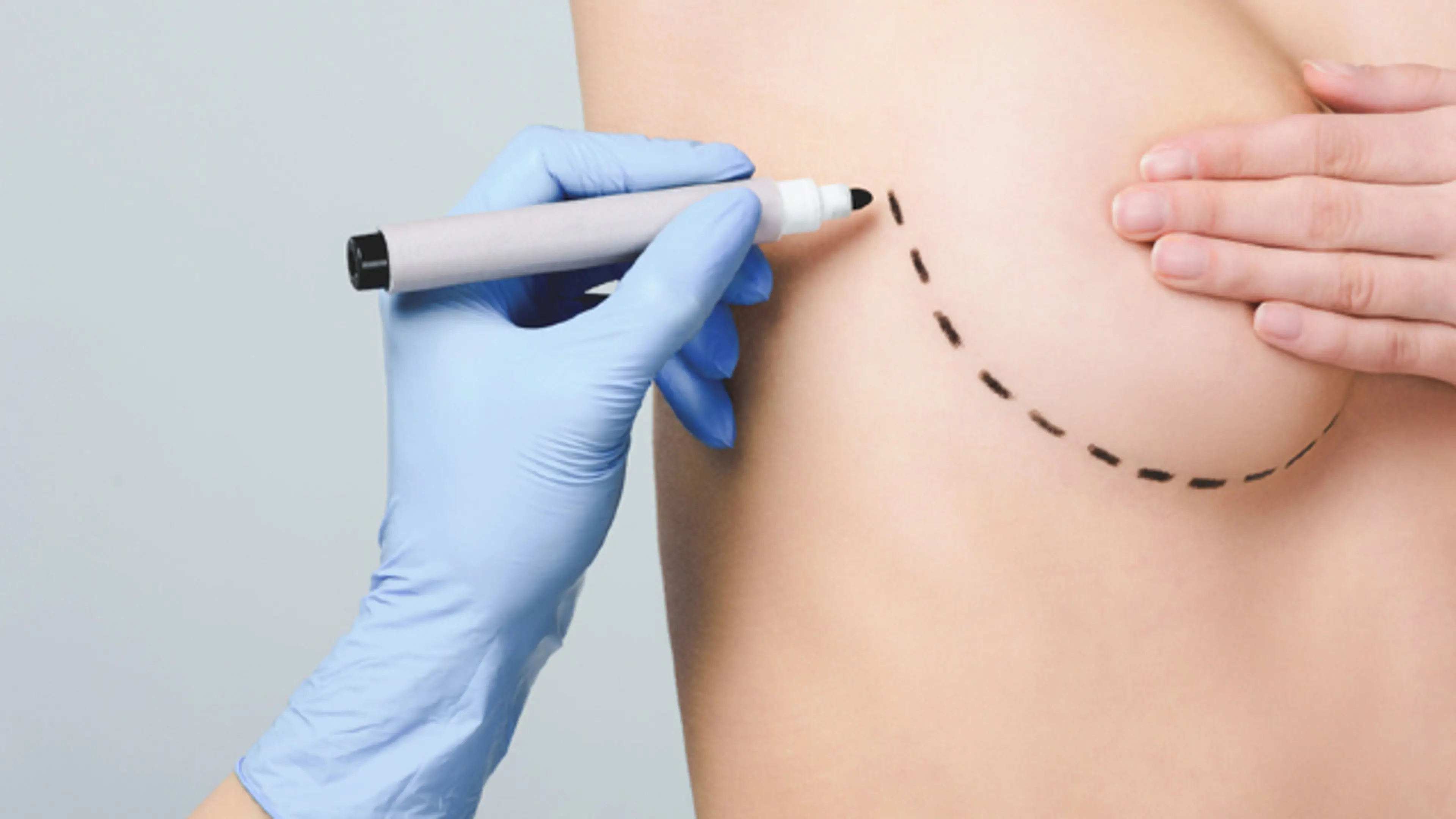Breast Surgery