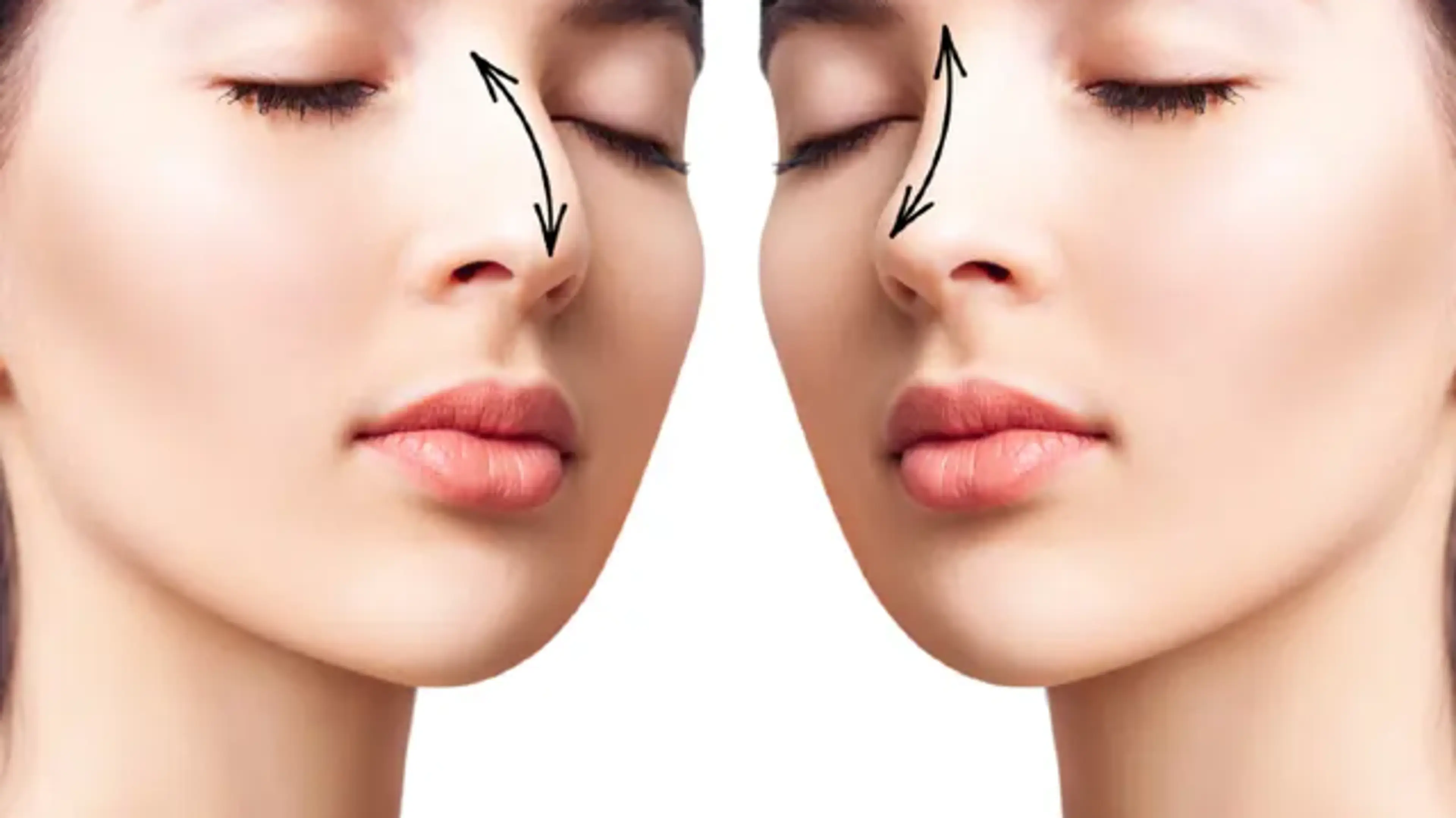 Rhinoplasty to help breathing