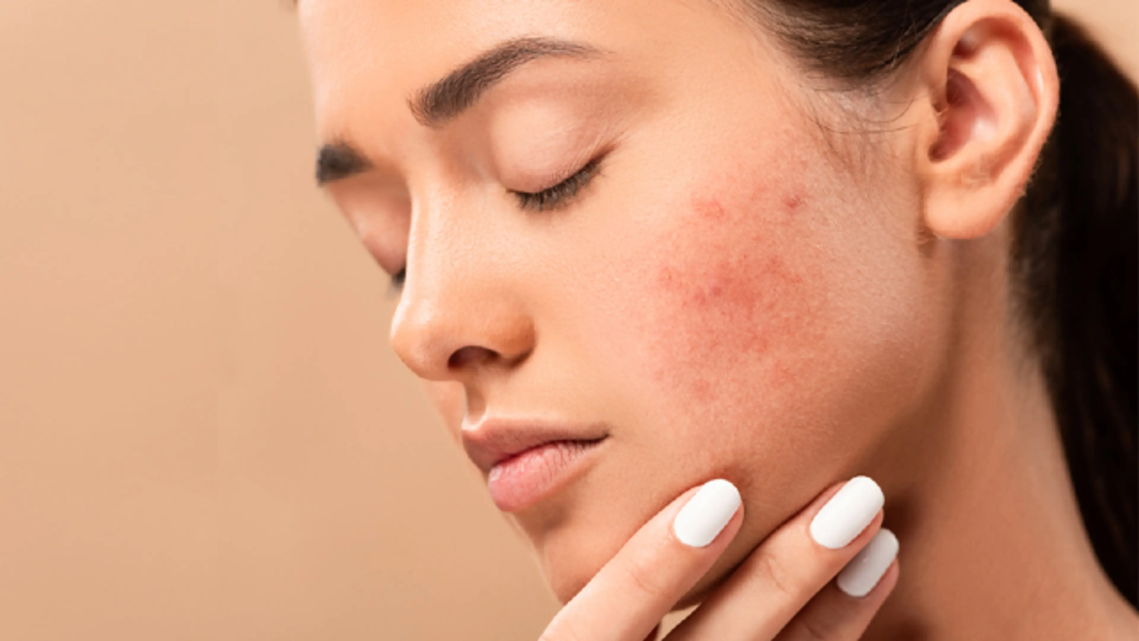 Acne scars.