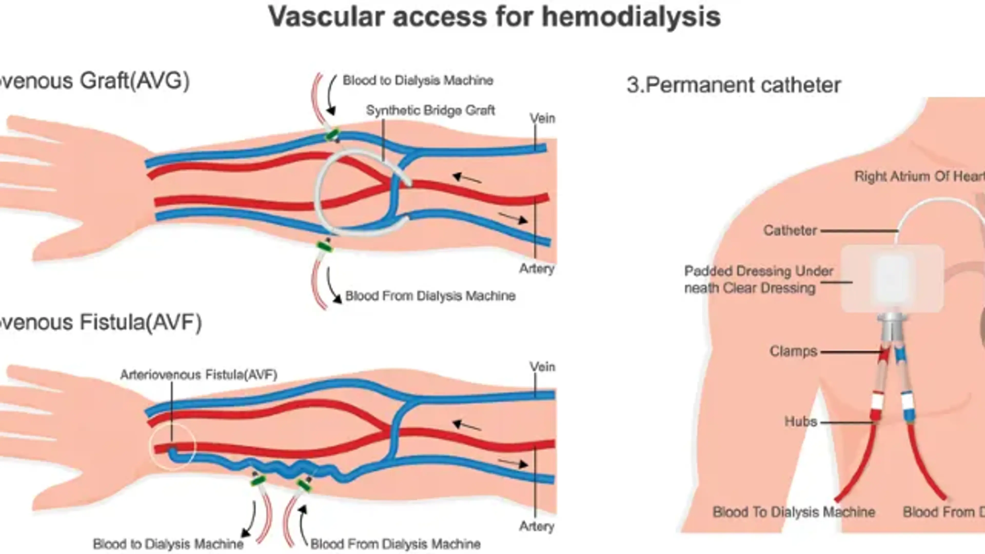 varicose veins types