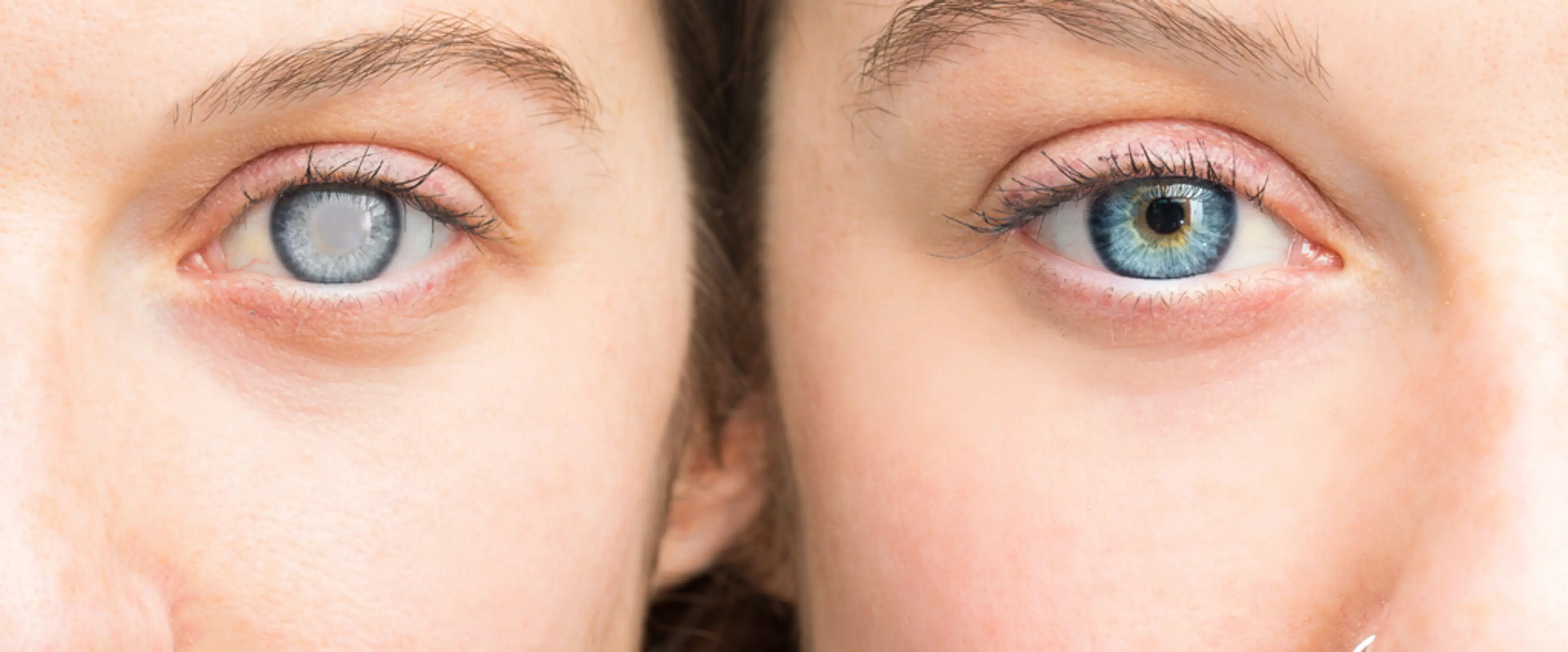 Global Ubal Eye Center