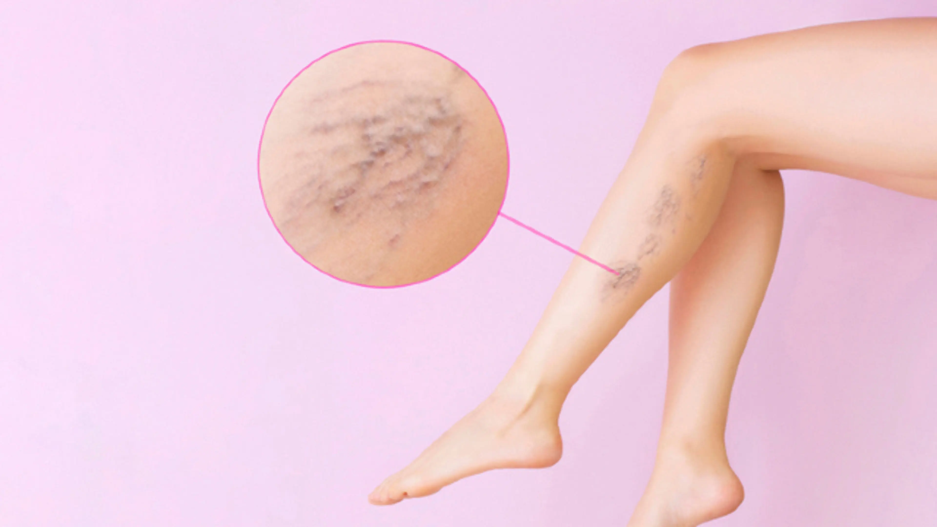 varicose vein