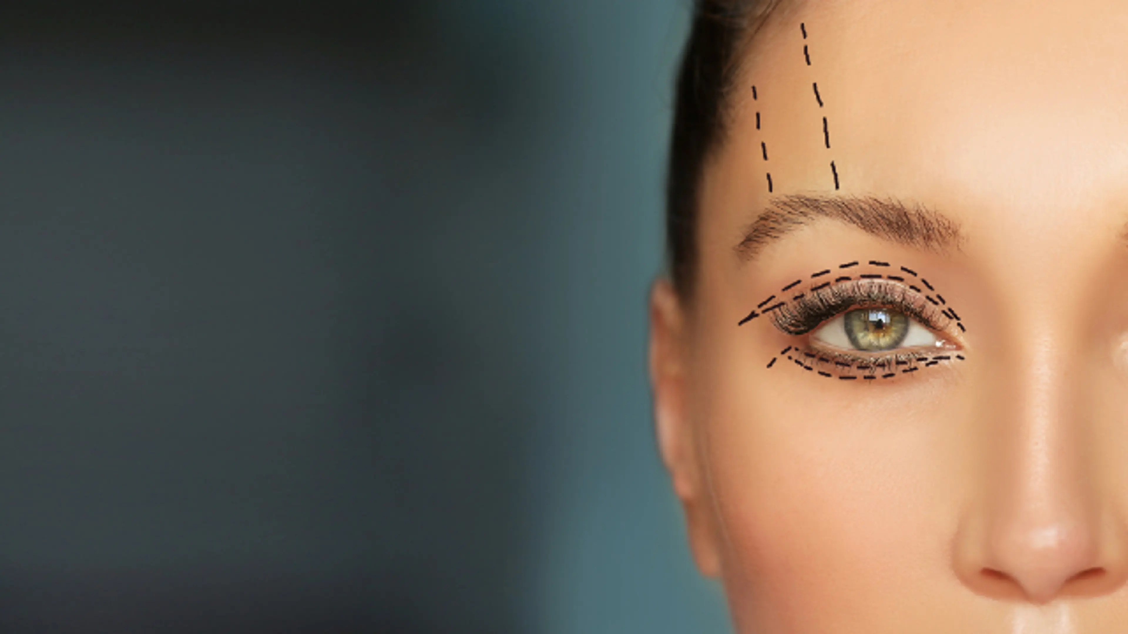 eyelid surgery