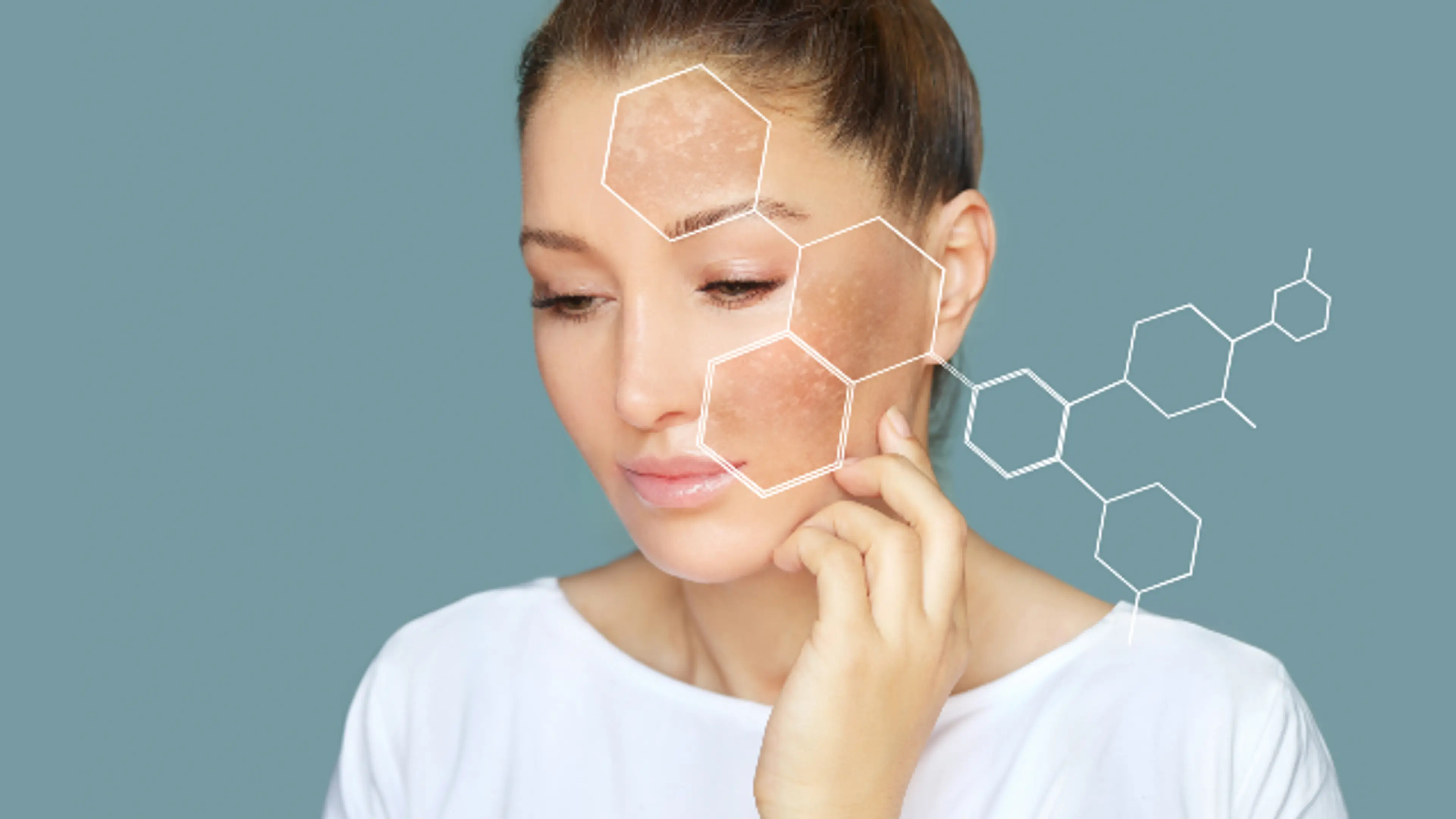 Melasma Condition.