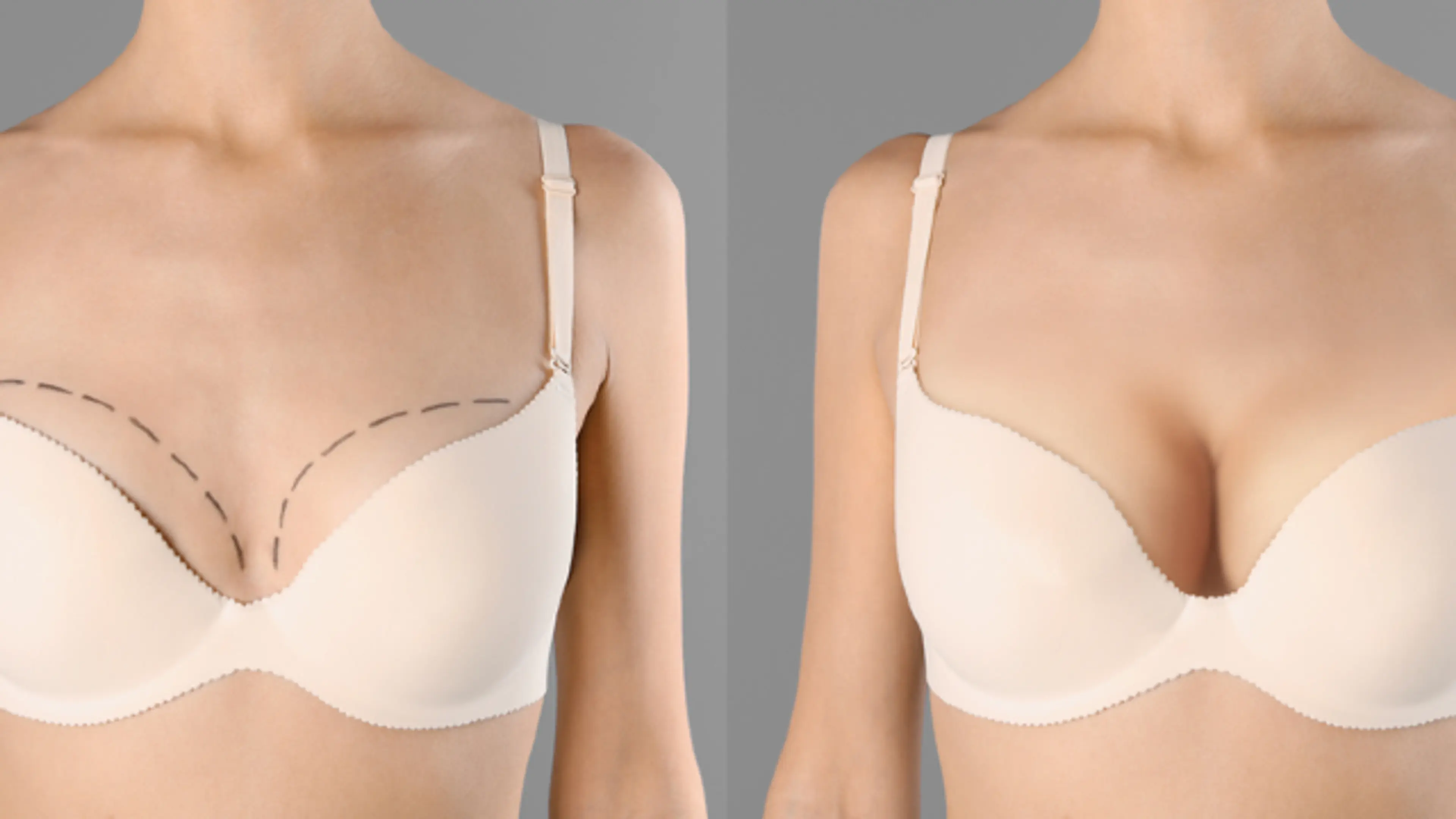 plastic surgery breast augmentation