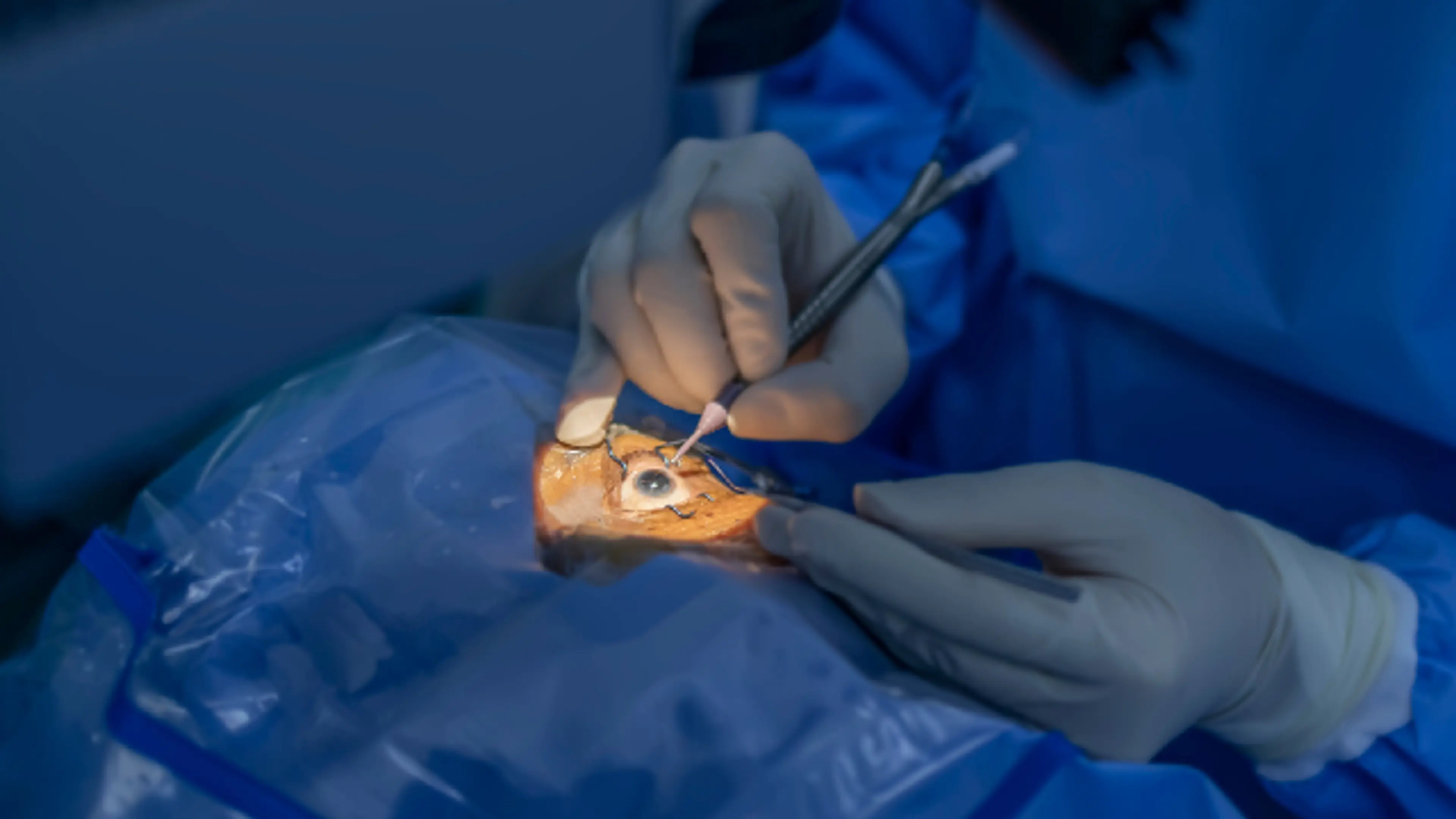 cataract surgery