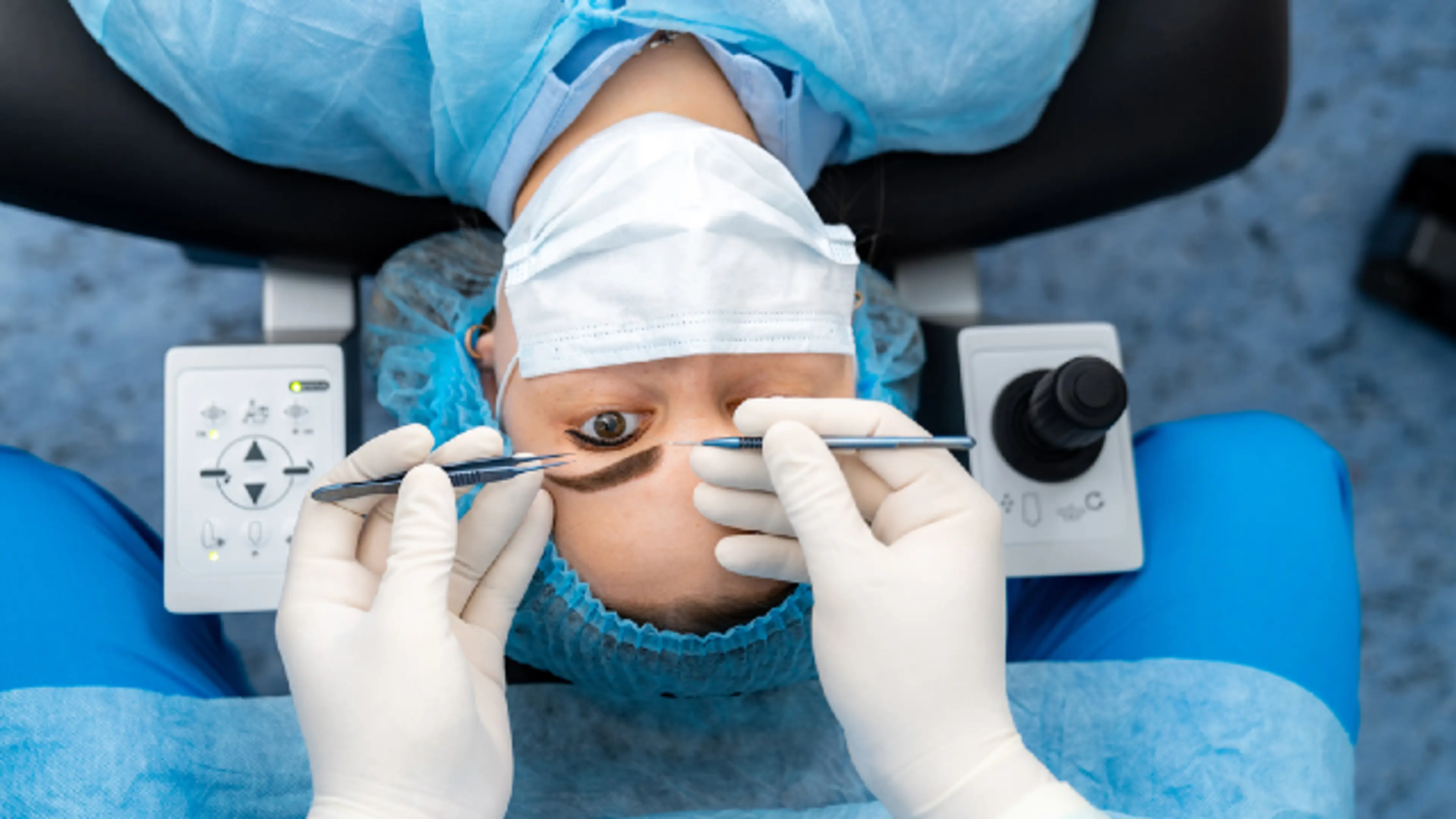 epicanthoplasty surgery