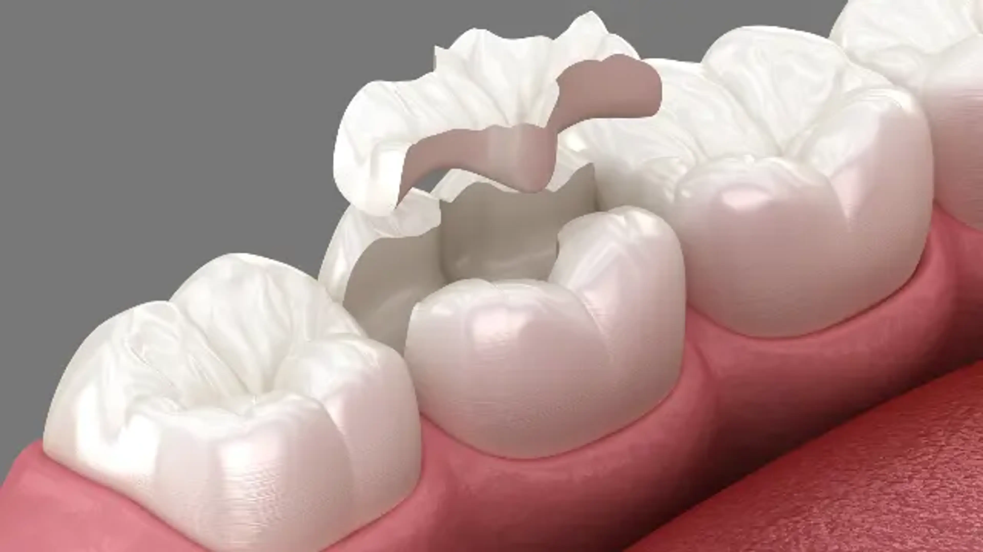 Dental Inlay Cost in South Korea