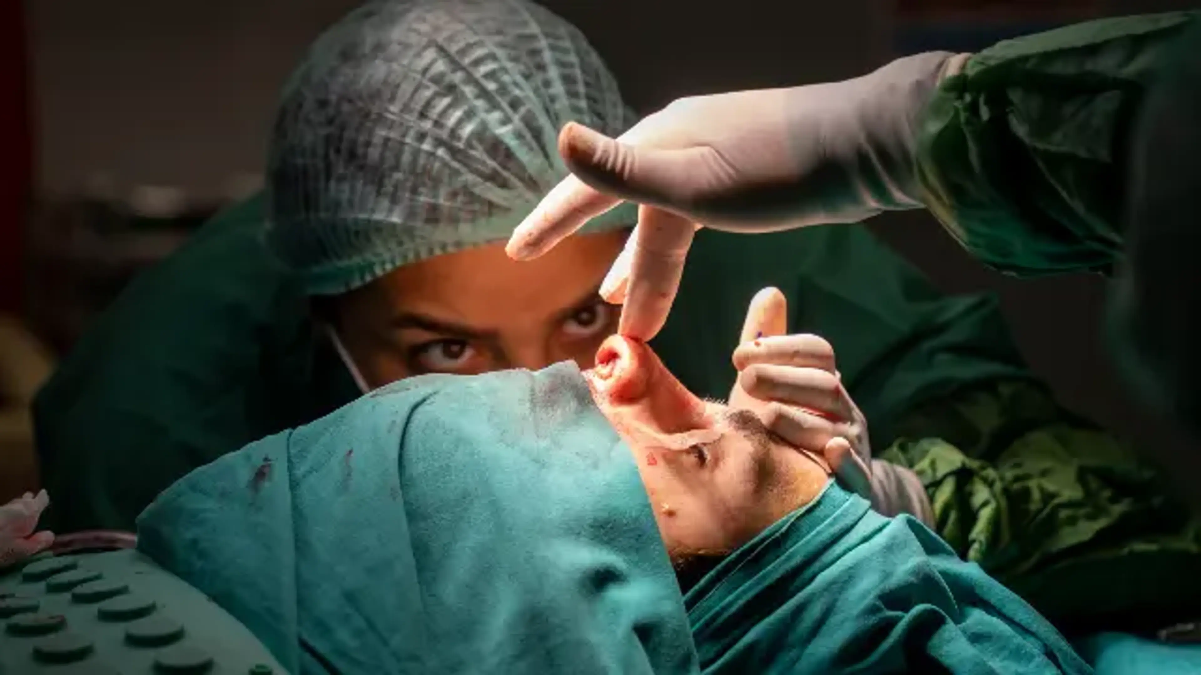 Revision Rhinoplasty srugery