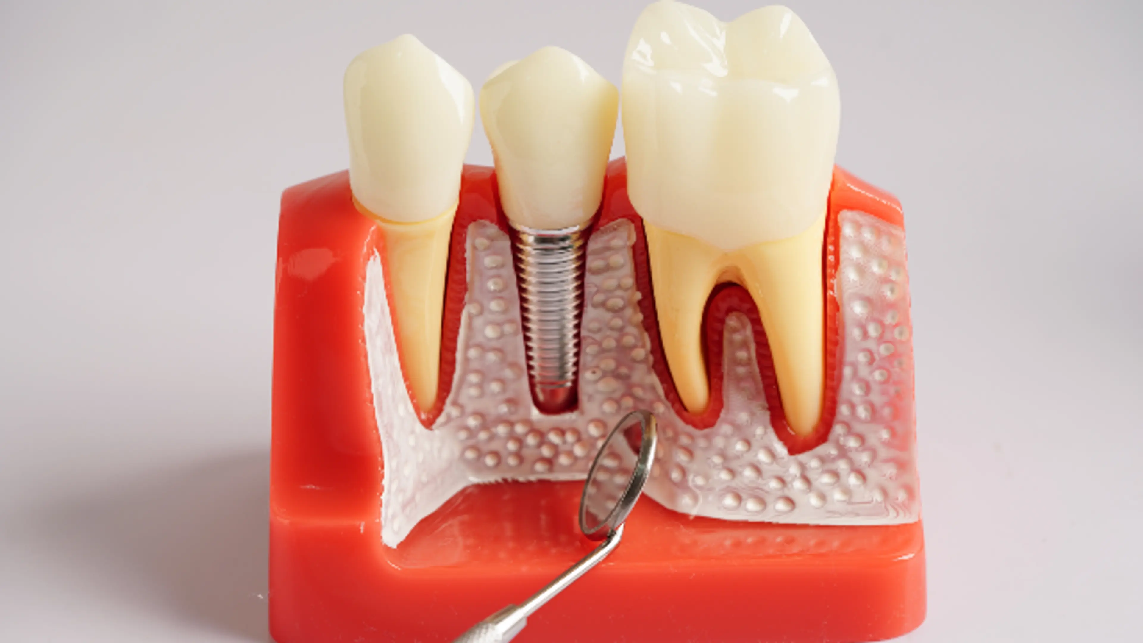 Root Canal Treatment At Ye-on Dental Clinic