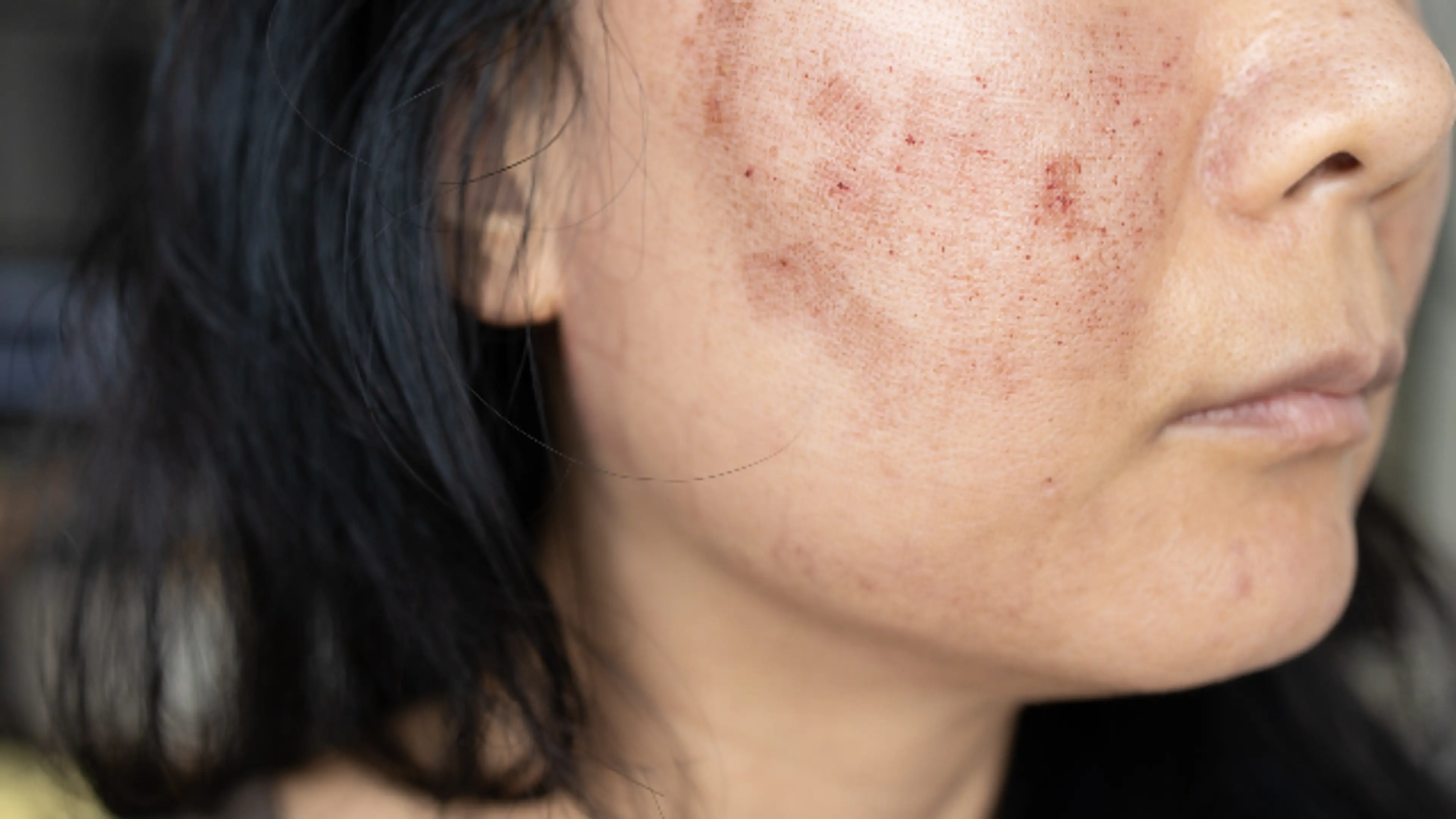 色素沈着（Pigmentation）