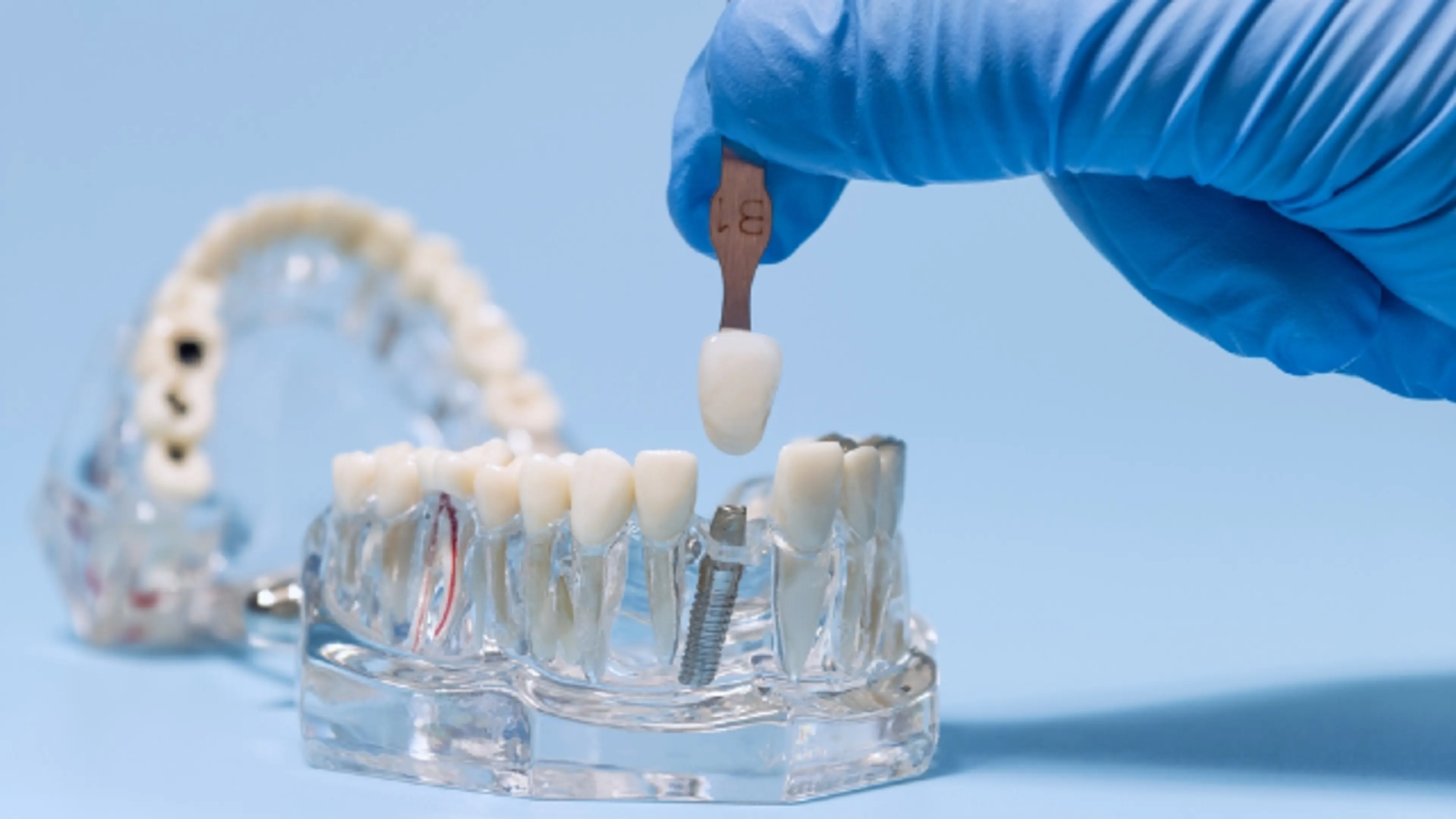 Full-Mouth Implants