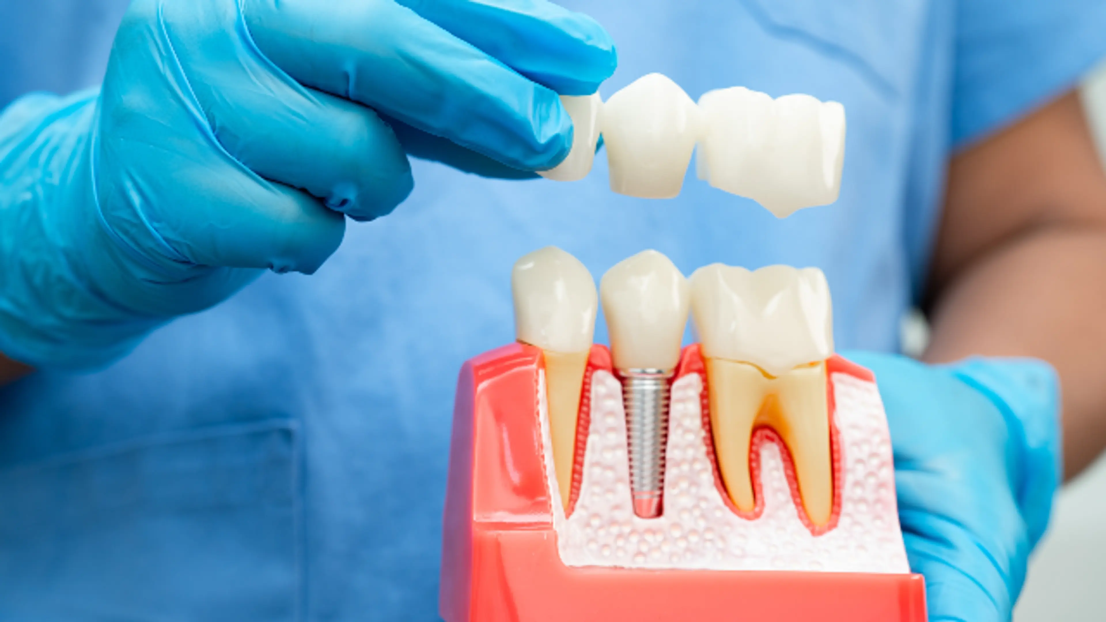 Dental Implants At OnO Dental Clinic