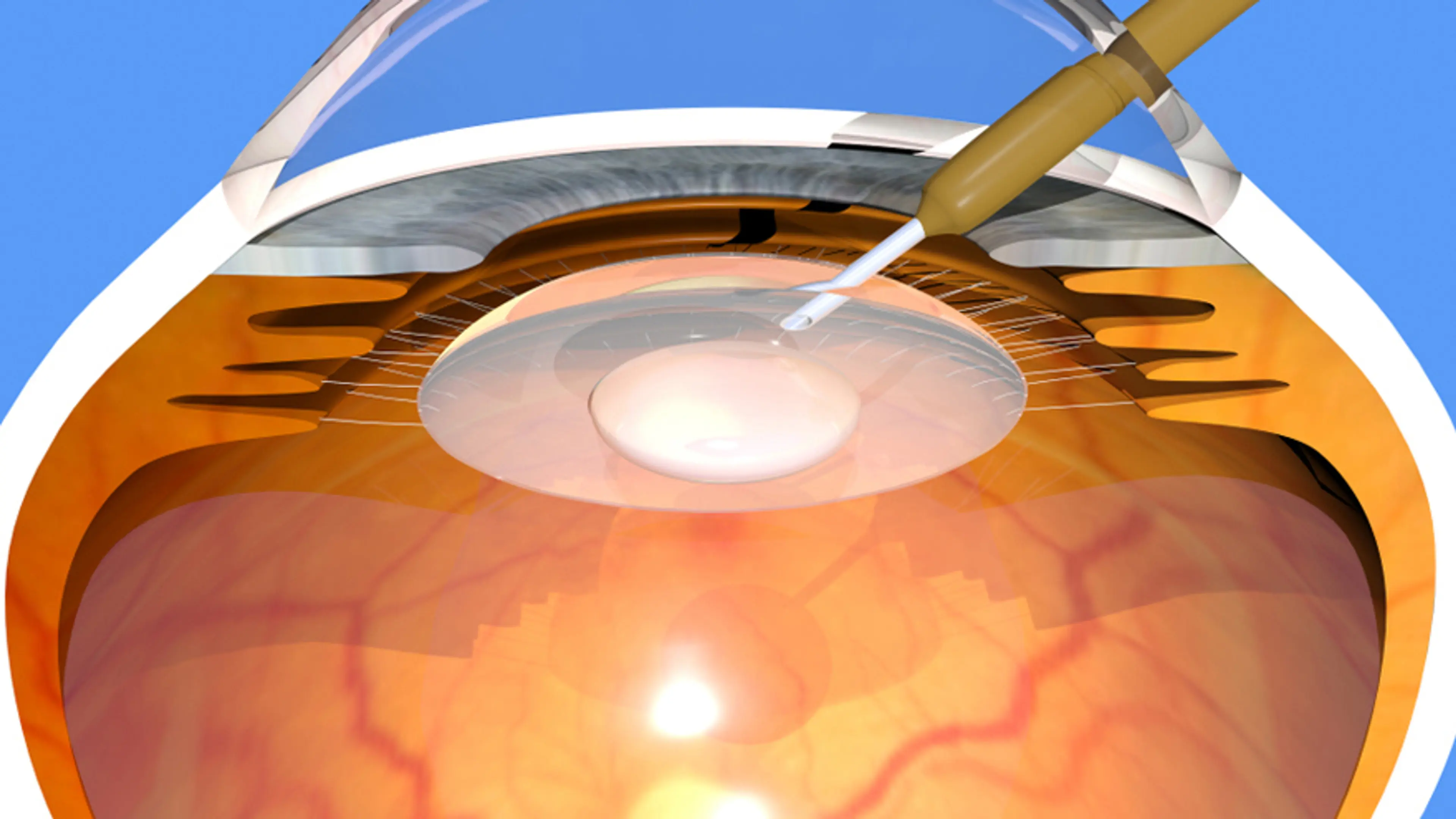 人工晶状体技术