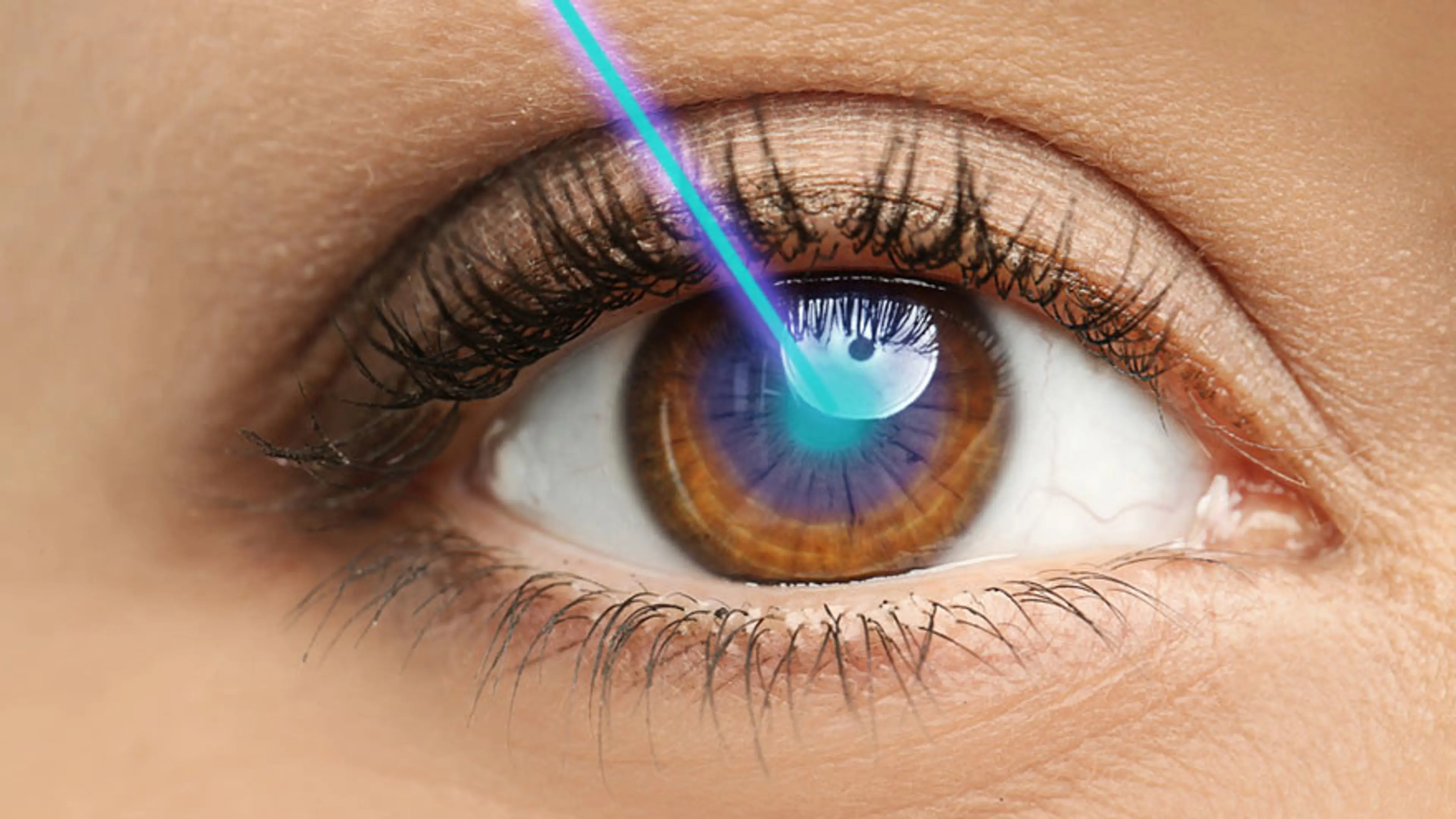 如何选择PRK、LASEK、SMILE和LASIK